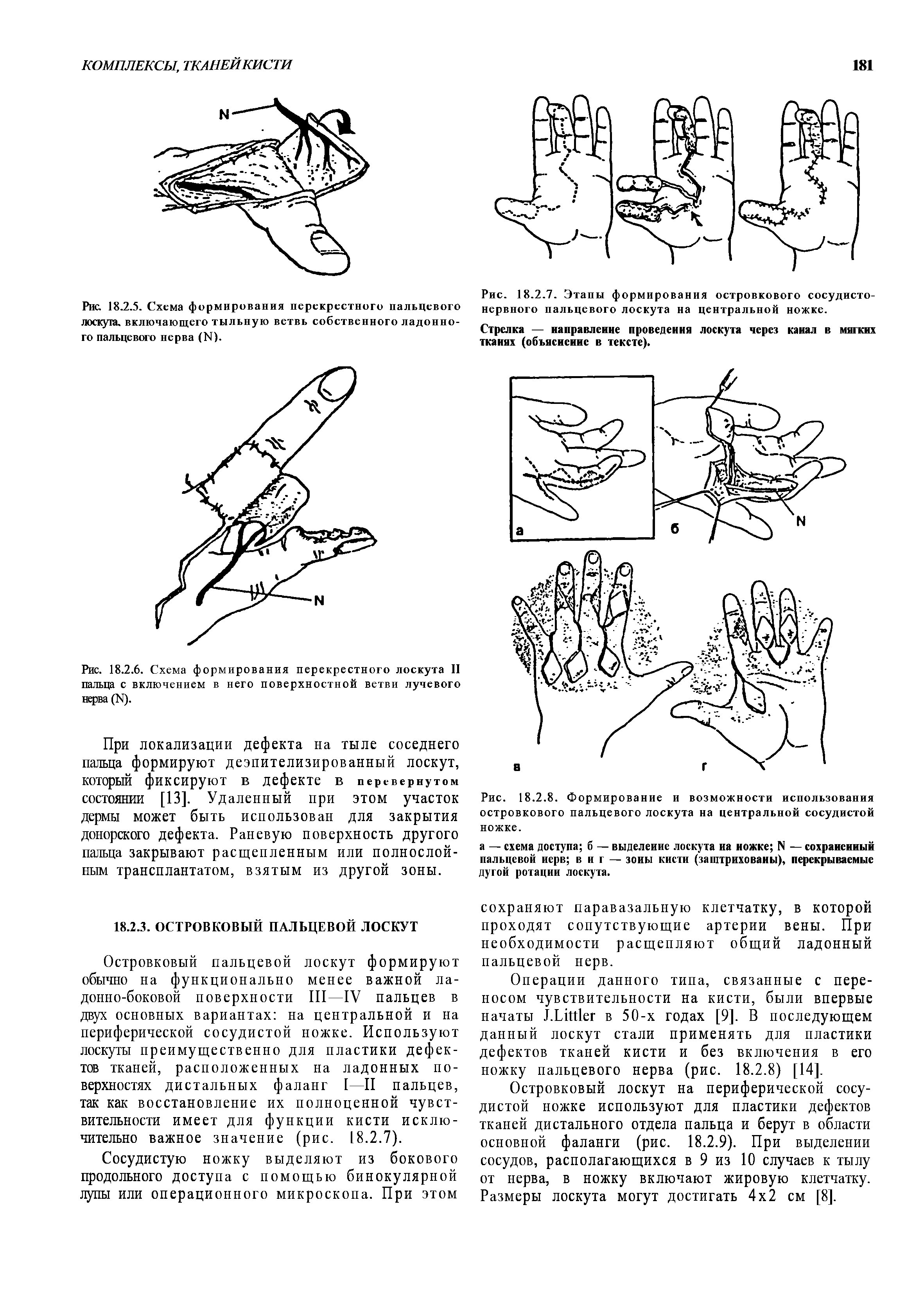 Рис. 18.2.8. Формирование и возможности использования островкового пальцевого лоскута на центральной сосудистой ножке.