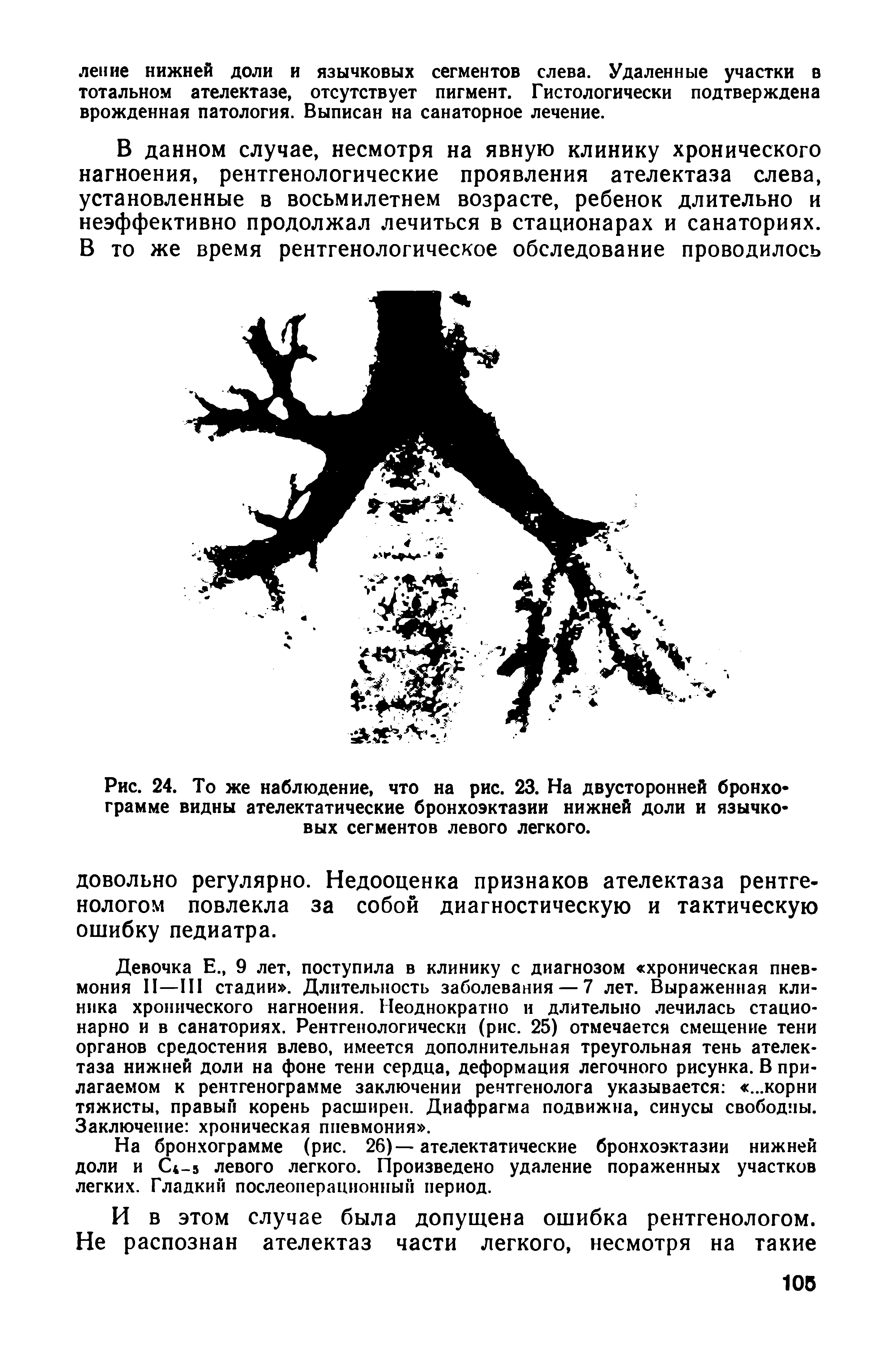 Рис. 24. То же наблюдение, что на рис. 23. На двусторонней бронхограмме видны ателектатические бронхоэктазии нижней доли и язычковых сегментов левого легкого.