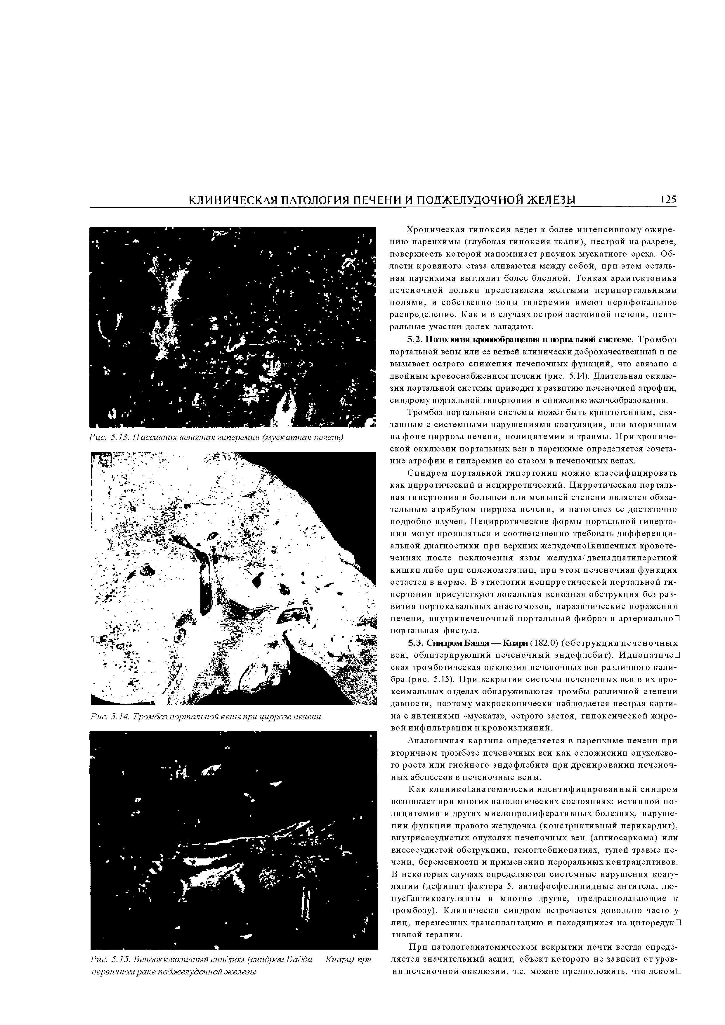 Рис. 5.15. Веноокклюзивный синдром (синдром Бадда — Киари) при первичном раке поджелудочной железы...