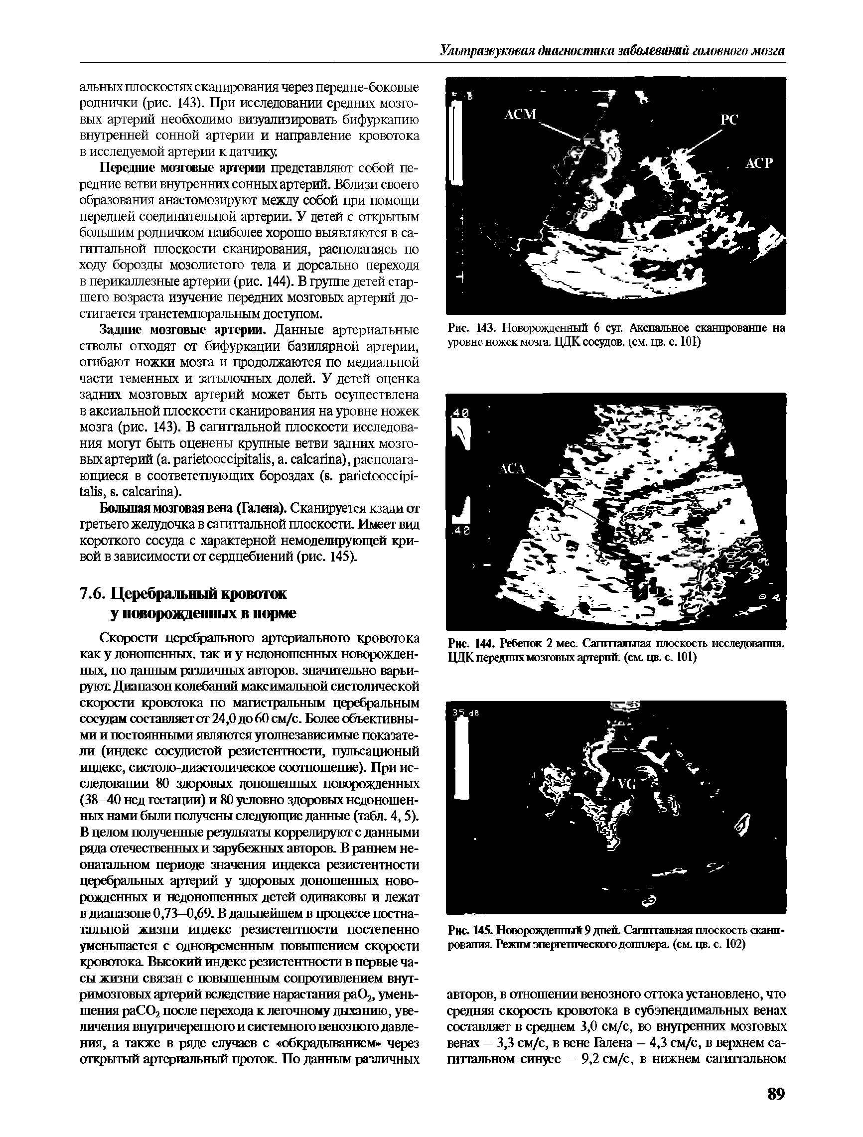 Рис. 145. Новорожденный 9 дней. Сагиттальная плоскость сканирования. Режим энергетического допплера, (см. цв. с. 102)...