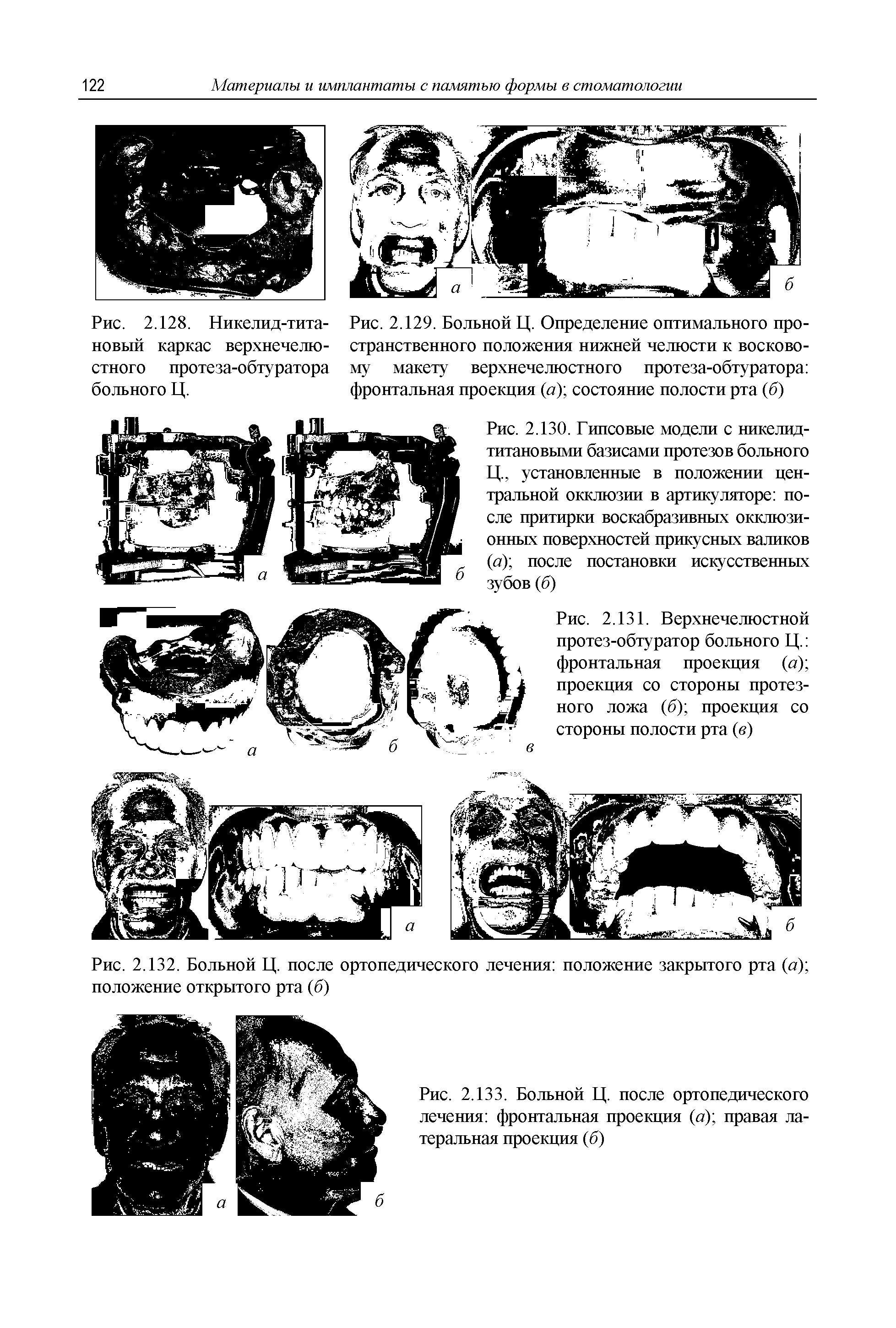 Рис. 2.130. Гипсовые модели с никелид-титановыми базисами протезов больного Ц., установленные в положении центральной окклюзии в артикуляторе после притирки воскабразивных окклюзионных поверхностей прикусных валиков (а) после постановки искусственных зубов (б)...