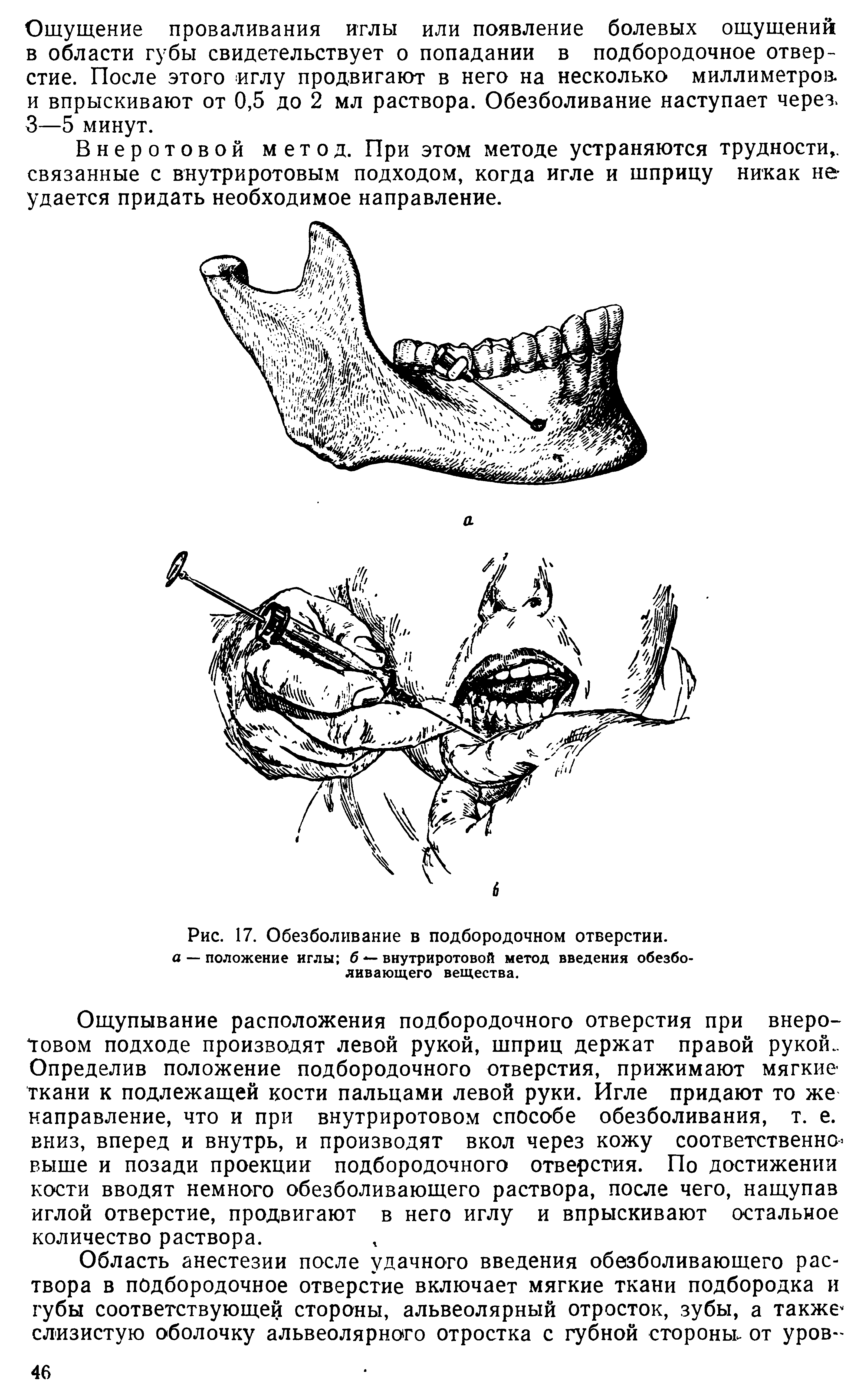 Рис. 17. Обезболивание в подбородочном отверстии. а — положение иглы б - внутриротовой метод введения обезболивающего вещества.