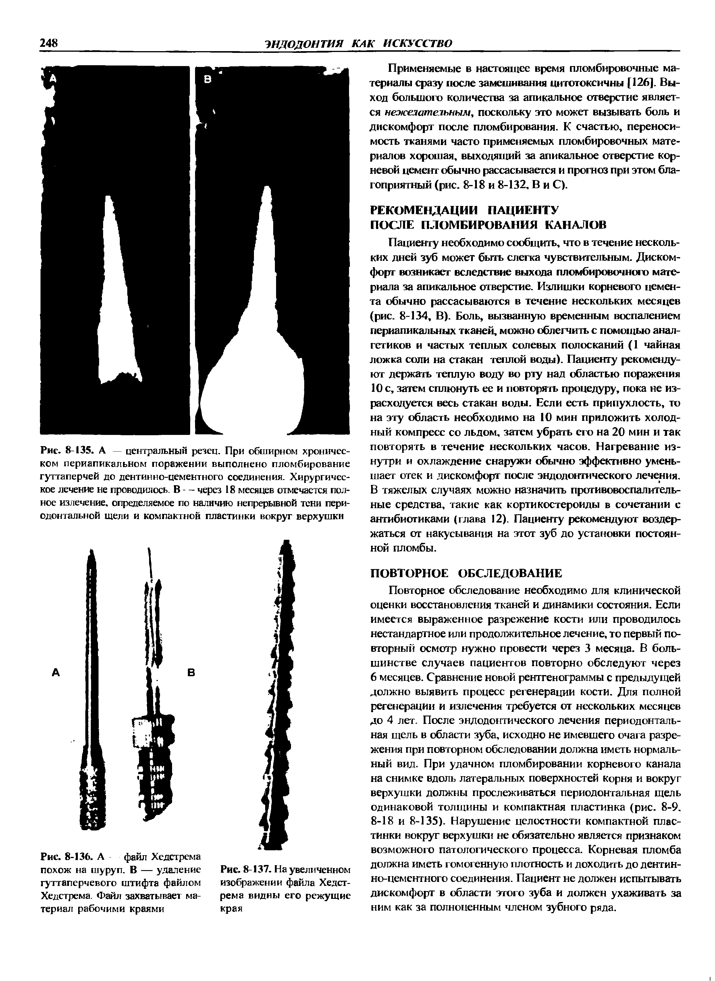 Рис. 8-136. А файл Хедстрема похож на шуруп. В — удаление гуттаперчевого штифта файлом Хедстрема. Файл захватывает материал рабочими краями...