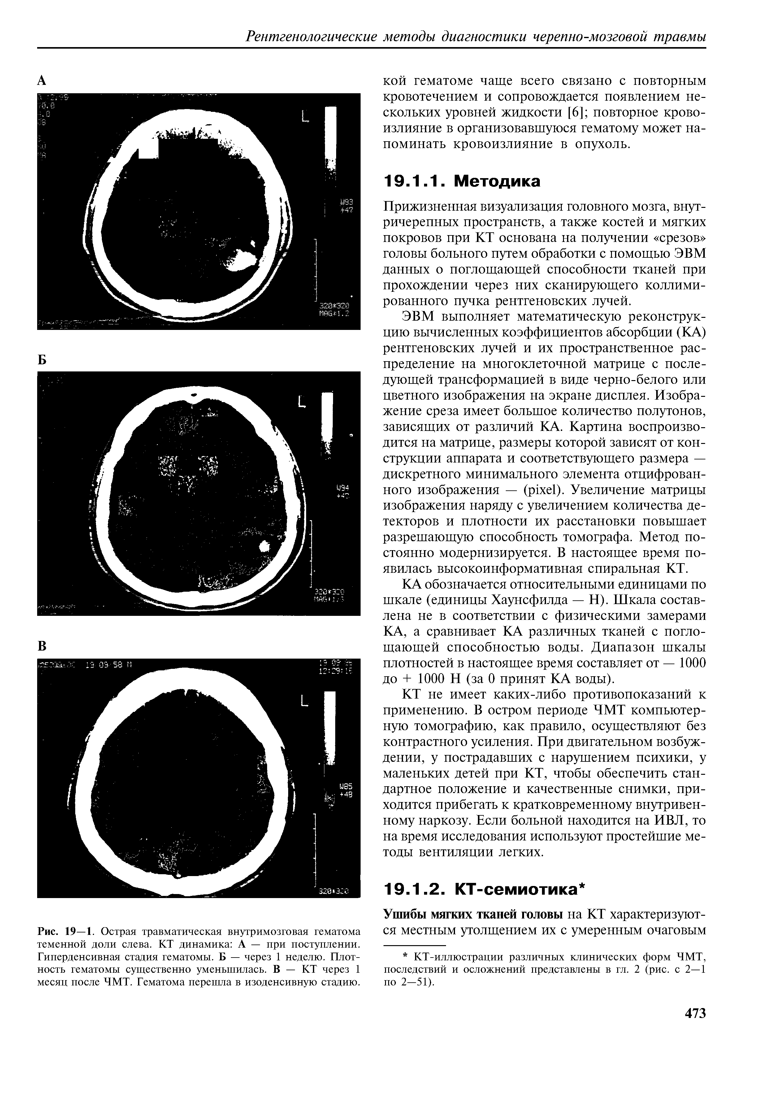 Рис. 19—1. Острая травматическая внутримозговая гематома теменной доли слева. КТ динамика А — при поступлении. Гиперденсивная стадия гематомы. Б — через 1 неделю. Плотность гематомы существенно уменьшилась. В — КТ через 1 месяц после ЧМТ. Гематома перешла в изоденсивную стадию.