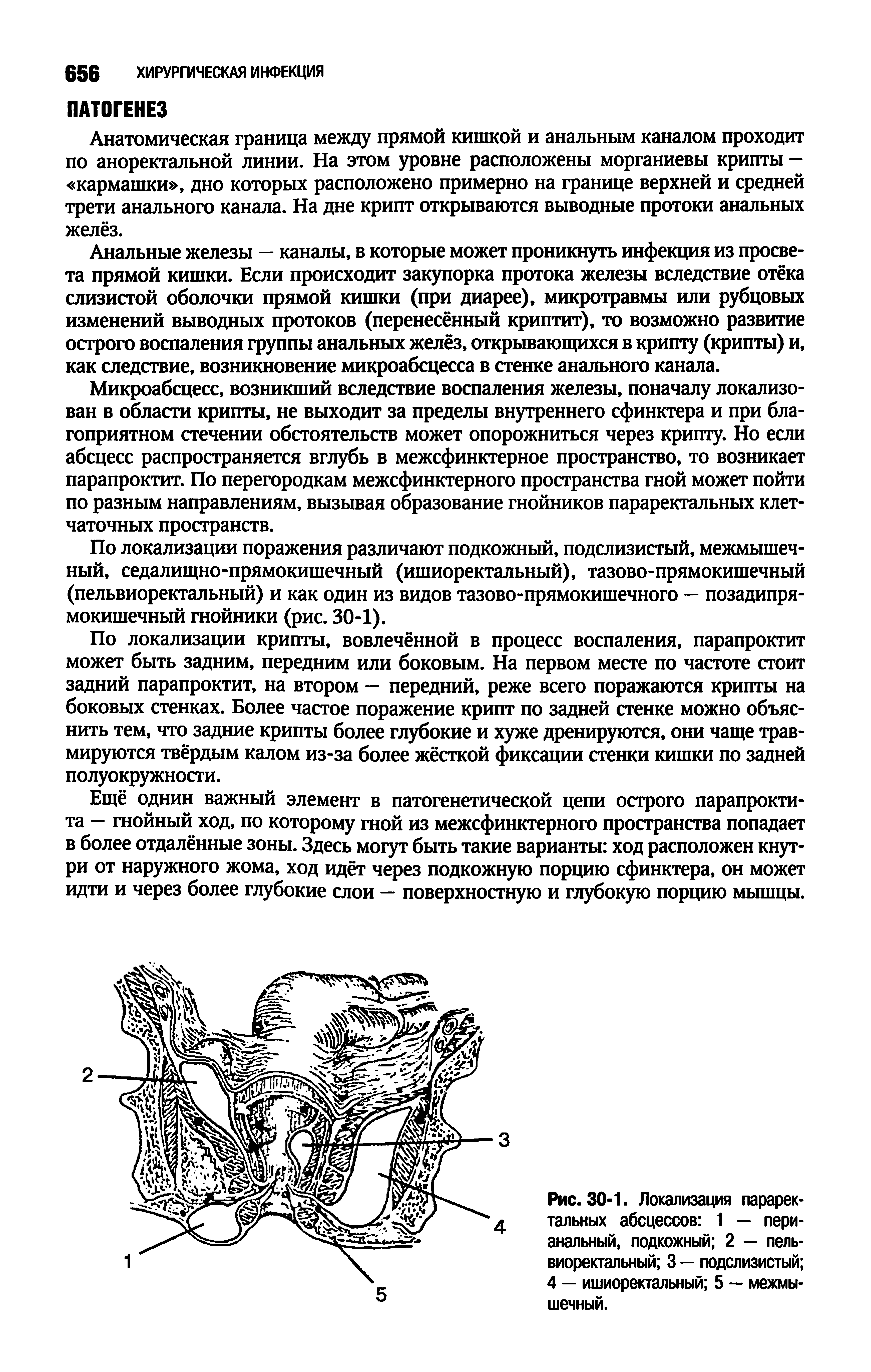 Рис. 30-1. Локализация параректальных абсцессов 1 — пери-анальный, подкожный 2 — пельвиоректальный 3 — подслизистый 4 — ишиоректальный 5 — межмышечный.