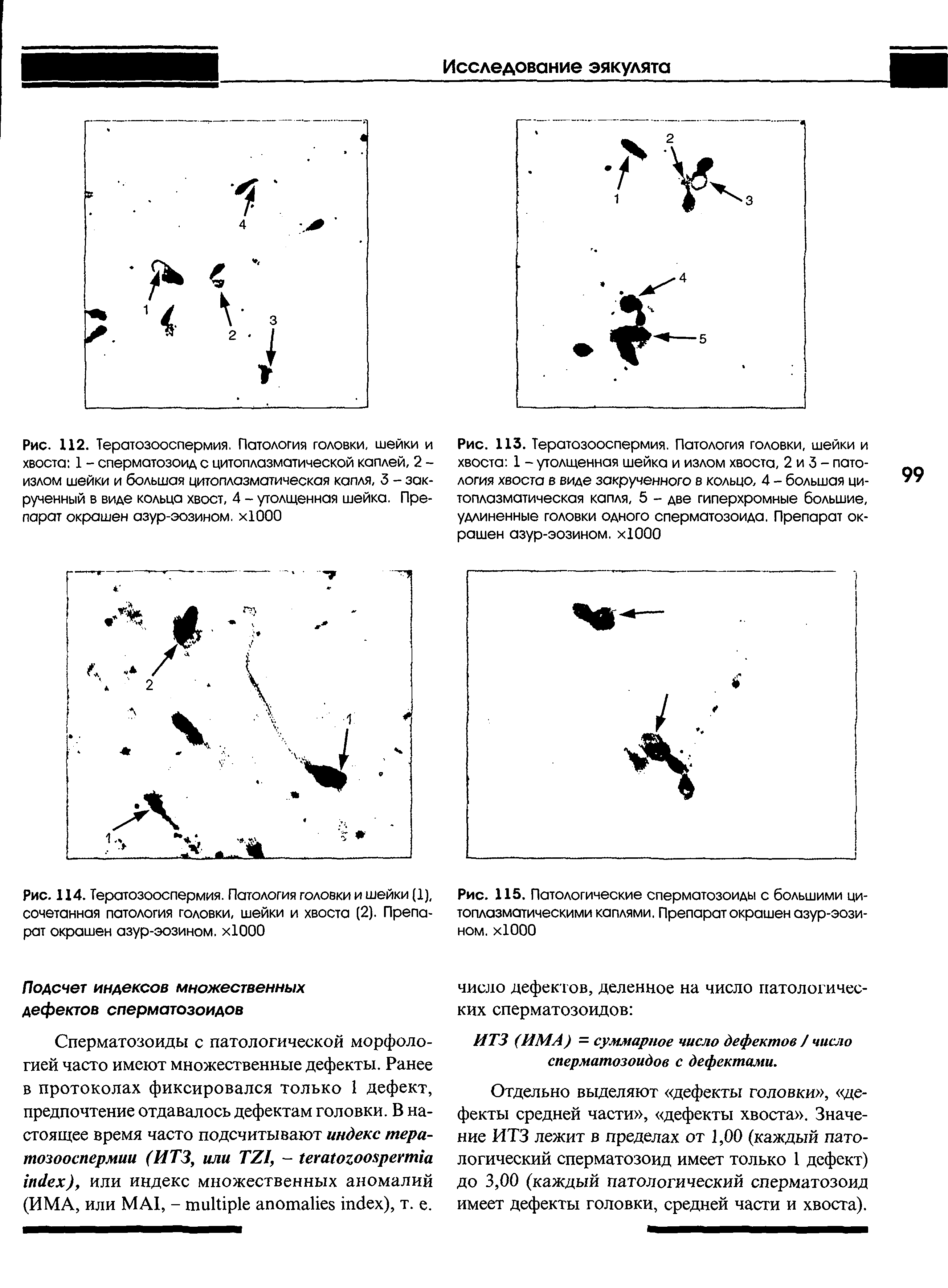 Рис. 112. Тератозооспермия. Патология головки, шейки и хвоста 1 - сперматозоид с цитоплазматической каплей, 2 -излом шейки и большая цитоплазматическая капля, 3 - закрученный в виде кольца хвост, 4 - утолщенная шейка. Препарат окрашен азур-эозином. Х1000...