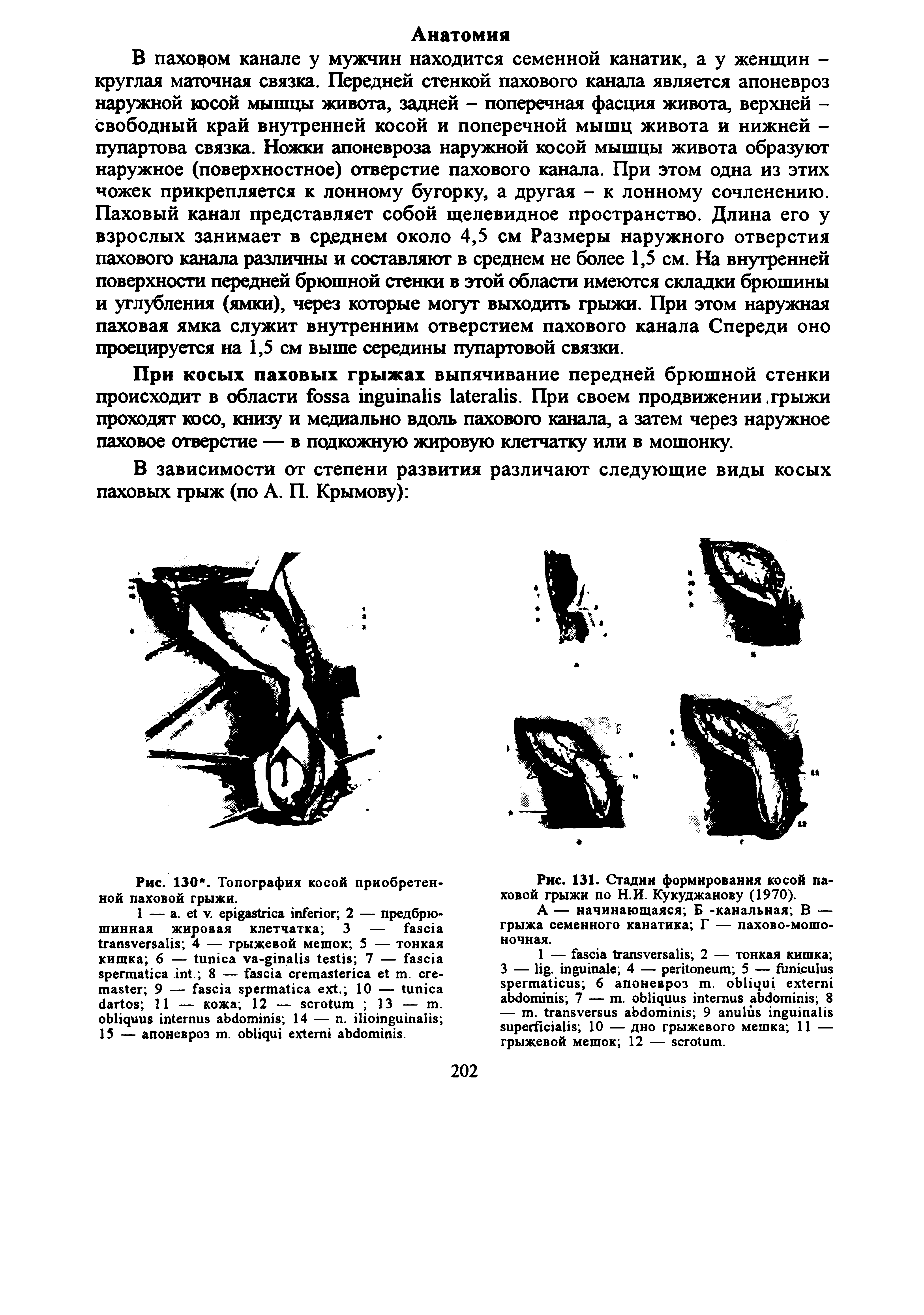 Рис. 131. Стадии формирования косой паховой грыжи по Н.И. Кукуджанову (1970).