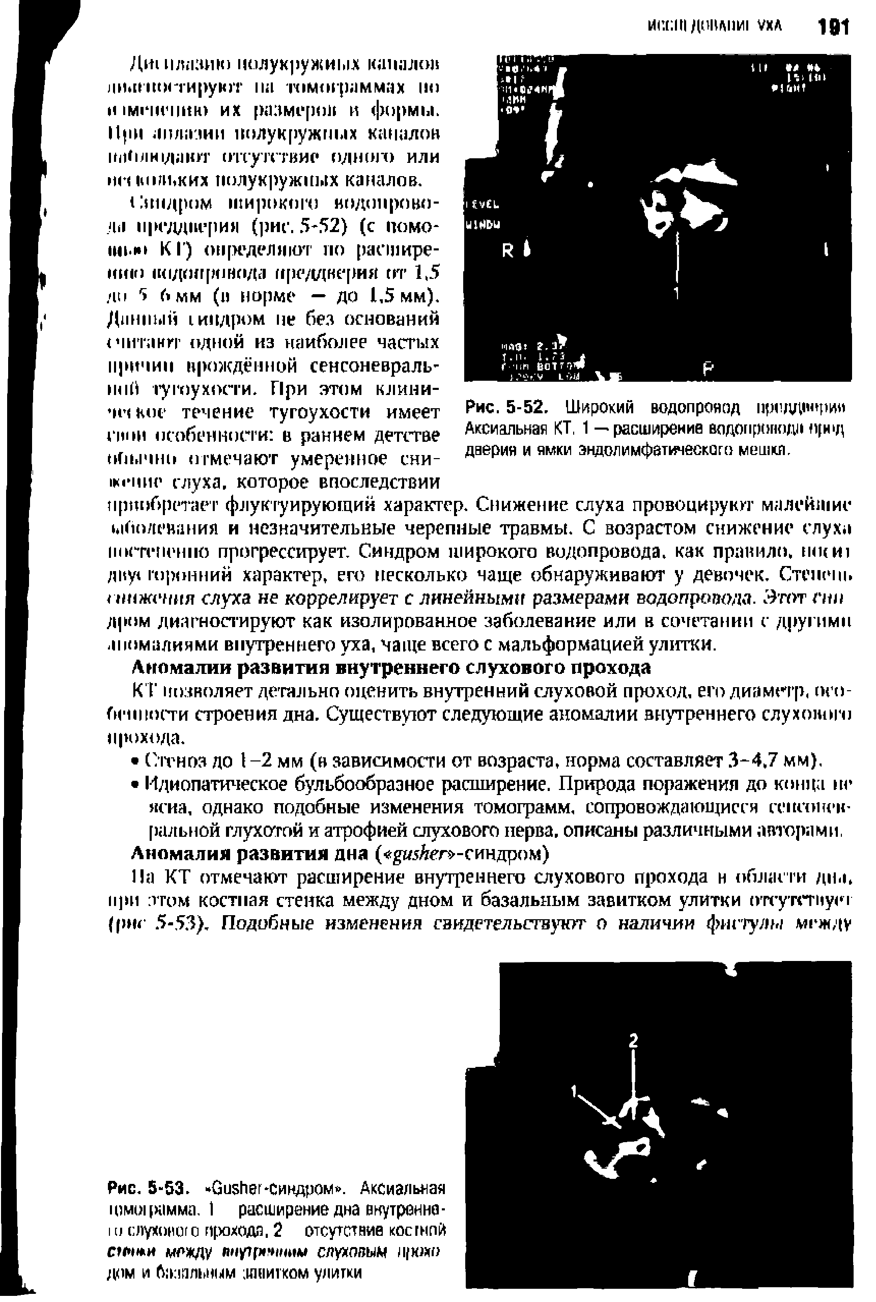 Рис. 5-53. G -Синдром . Аксиальная шмоцх1мма. 1 расширение дна внутренне-I о слуховою прохода, 2 отсутствие косгнпй сннжи между пнутрлным слуховым п юхо дом и б пильным завитком улитки...