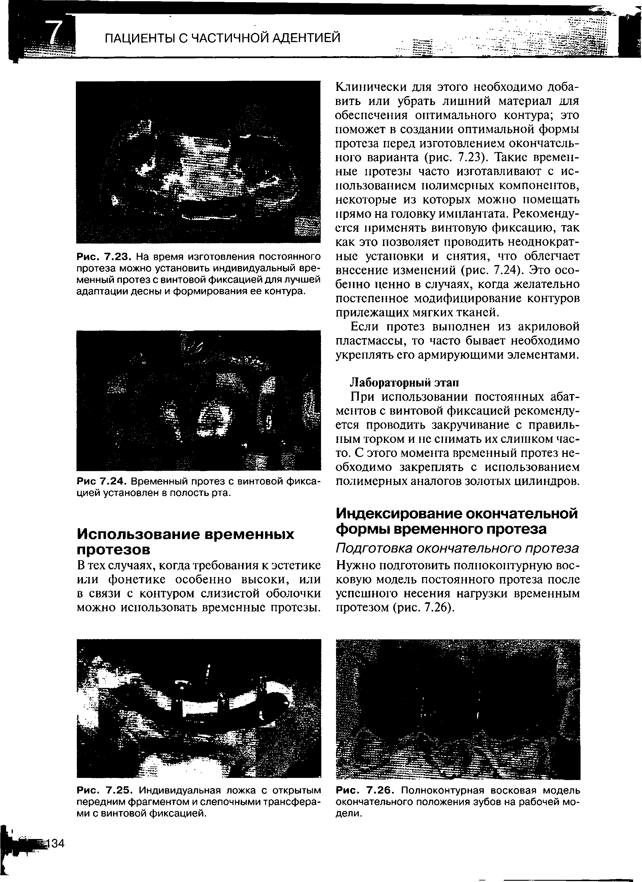 Рис. 7.25. Индивидуальная ложка с открытым передним фрагментом и слепочными трансферами с винтовой фиксацией.