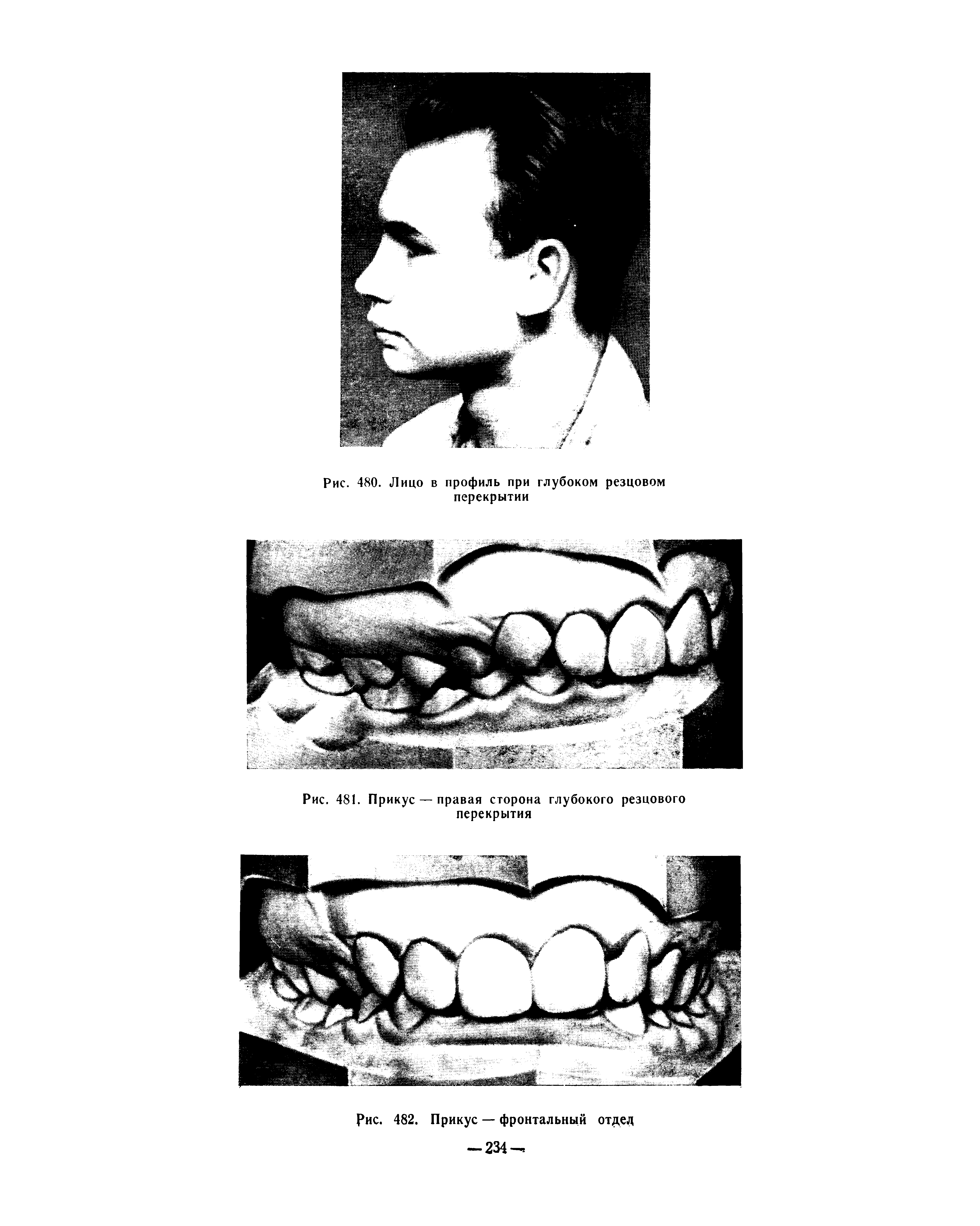 Рис. 481. Прикус — правая сторона глубокого резцового перекрытия...