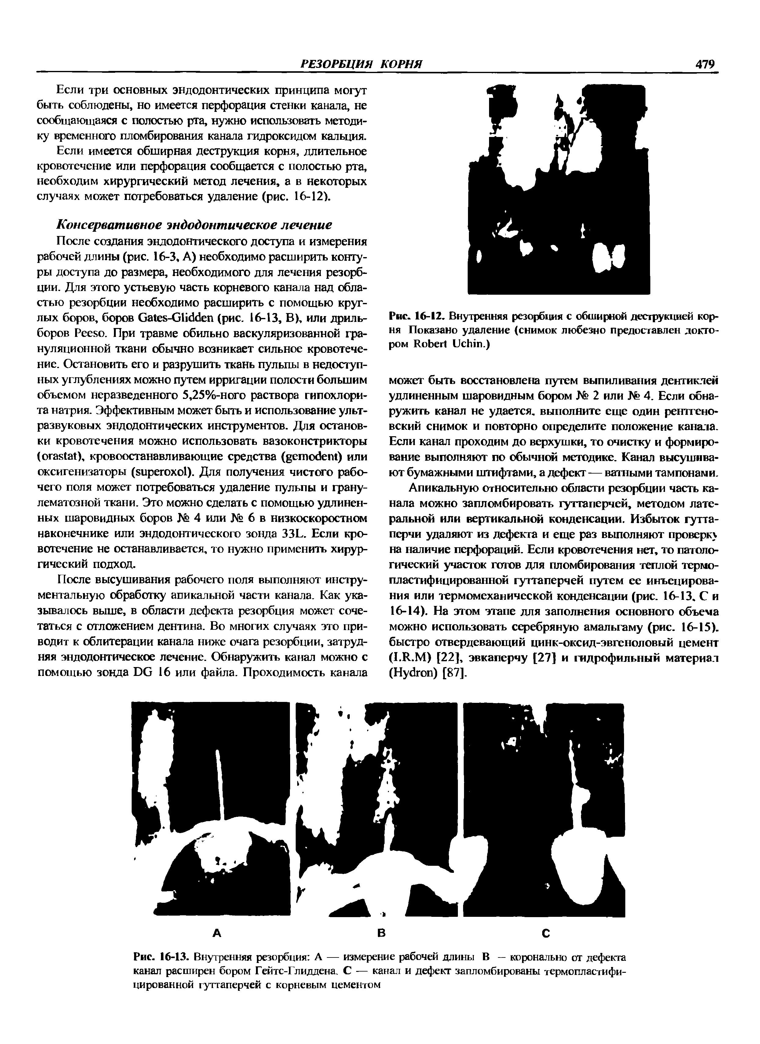 Рис. 16-13. Внутренняя резорбция А — измерение рабочей длины В — коронально от дефекта канал расширен бором Гейтс-Глиддена. С — канал и дефект запломбированы термопластифицированной гуттаперчей с корневым цементом...