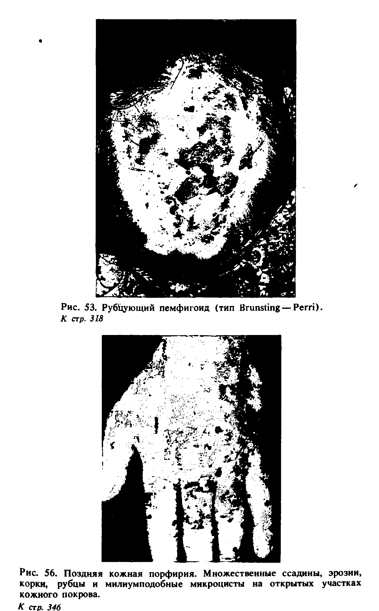 Рис. 56. Поздняя кожная порфирия. Множественные ссадины, эрозии, корки, рубцы и милиумподобные микроцисты на открытых участках кожного покрова.