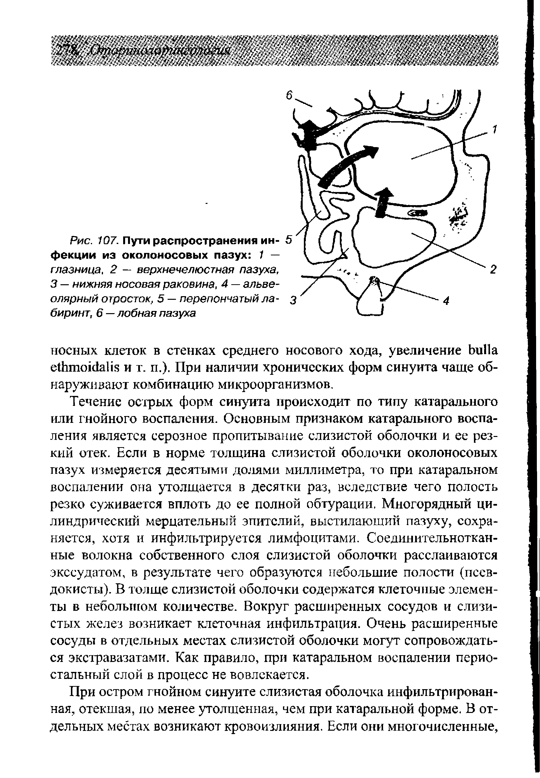 Рис. 107. Пути распространения инфекции из околоносовых пазух 1 — глазница, 2 — верхнечелюстная пазуха, 3 — нижняя носовая раковина, 4 — альвеолярный отросток, 5 — перепончатый лабиринт, 6 — лобная пазуха...