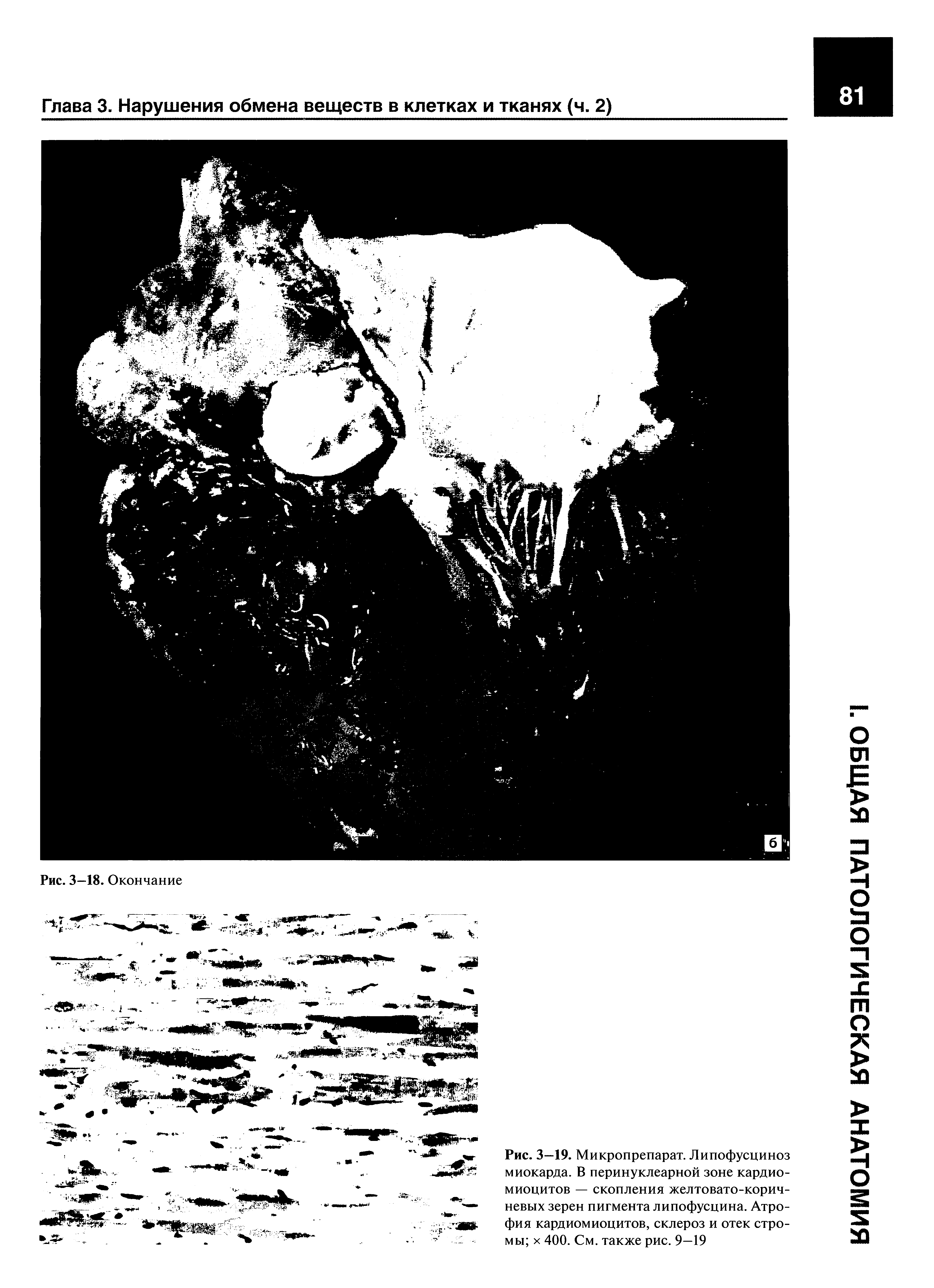 Рис. 3—19. Микропрепарат. Липофусциноз миокарда. В перинуклеарной зоне кардиомиоцитов — скопления желтовато-коричневых зерен пигмента липофусцина. Атрофия кардиомиоцитов, склероз и отек стромы х 400. См. также рис. 9—19...