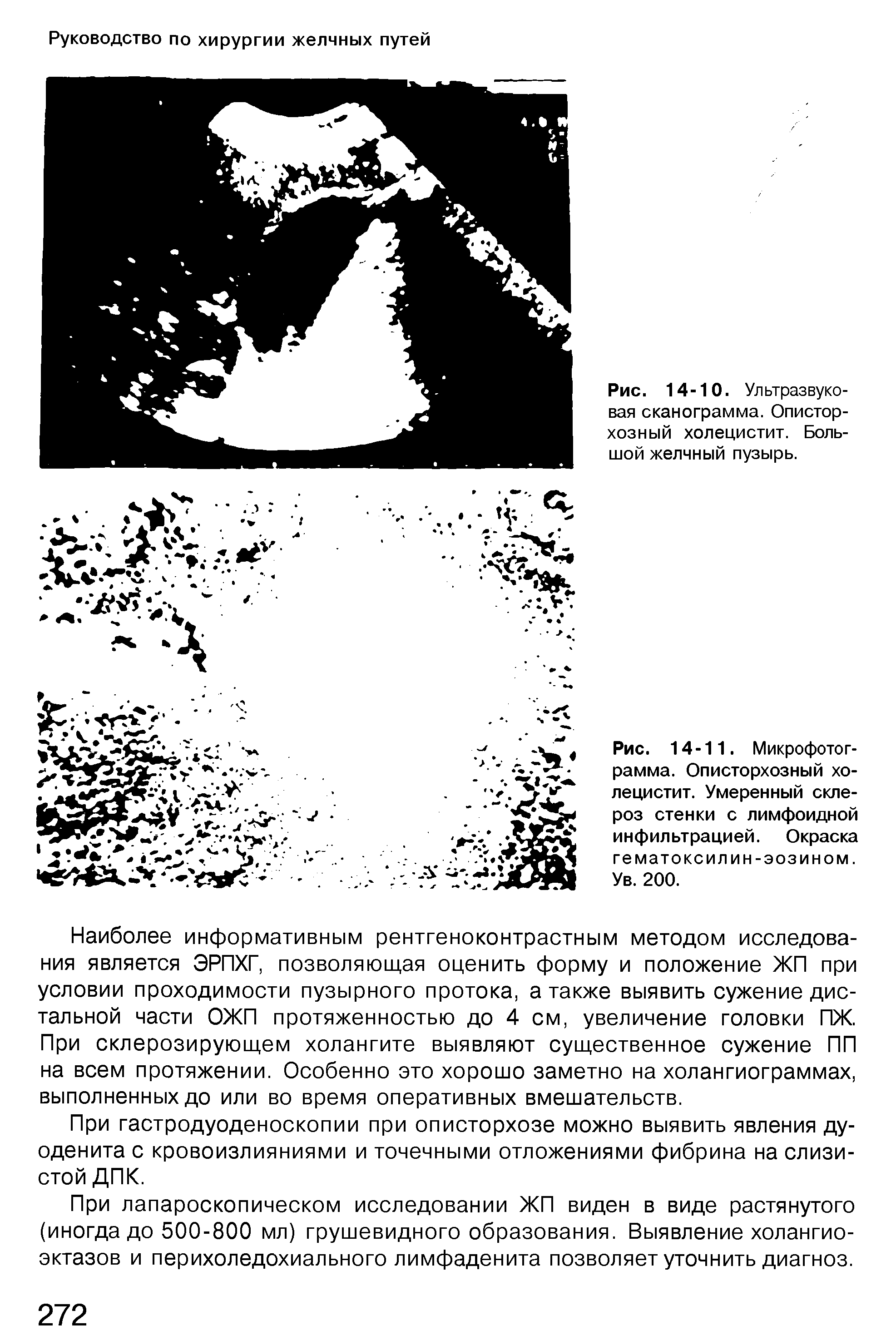 Рис. 14-11. Микрофотограмма. Описторхозный холецистит. Умеренный склероз стенки с лимфоидной инфильтрацией. Окраска гематоксилин-эозином. Ув. 200.