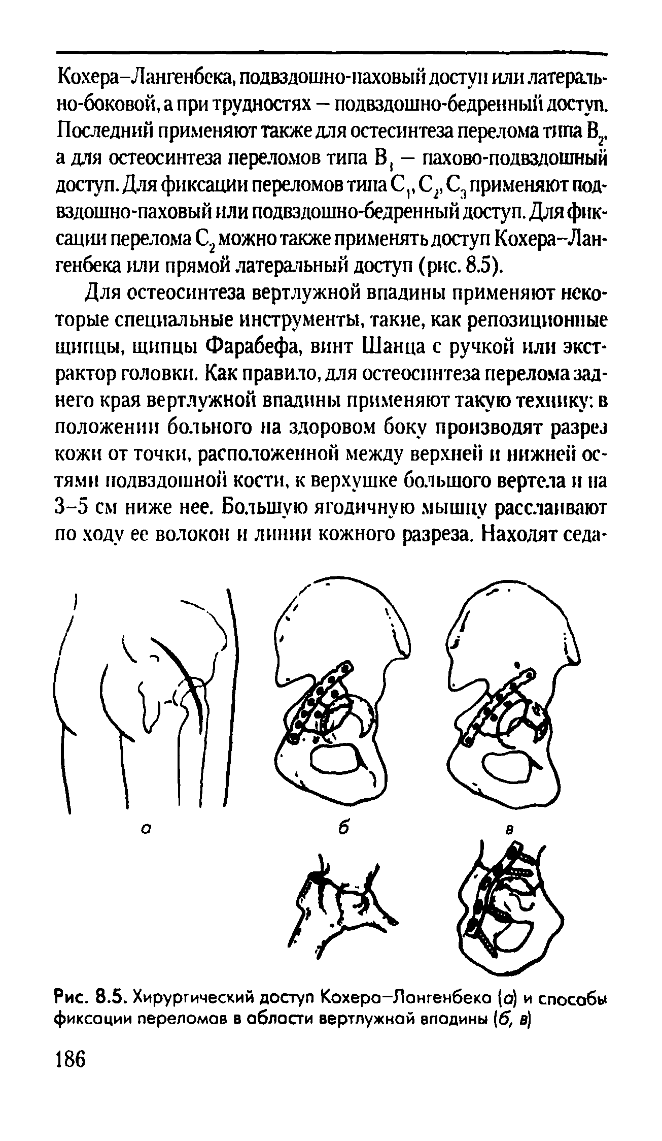 Рис. 8.5. Хирургический доступ Кохеро-Лонгенбеко (о) и способы фиксации переломав в области вертлужной впадины (б, в)...