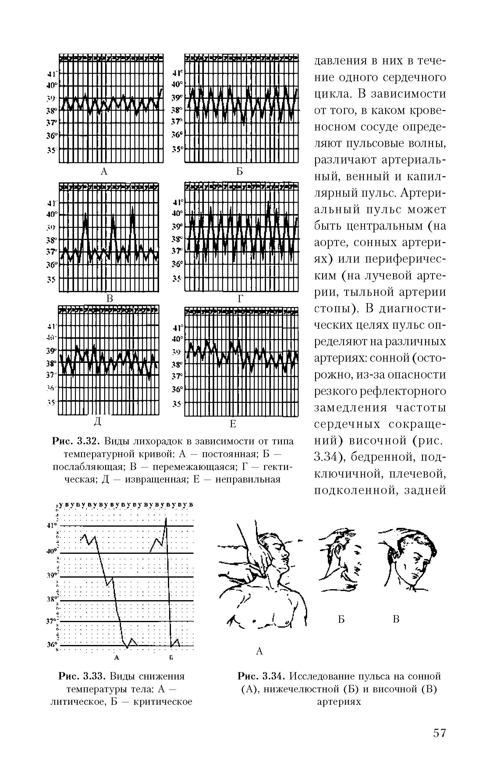 Рис. 3.34. Исследование пульса на сонной (А), нижечелюстной (Б) и височной (В) артериях...