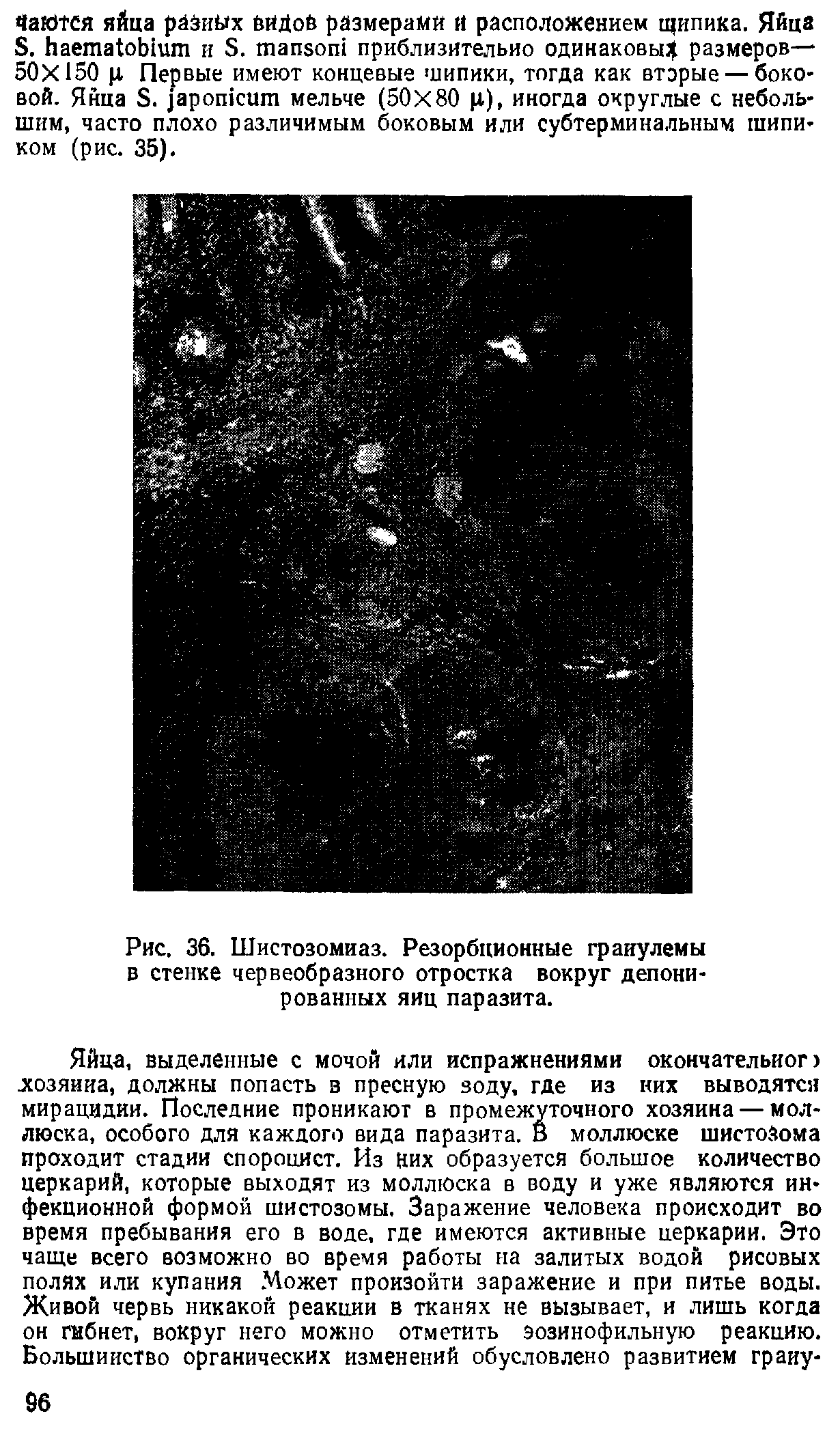 Рис. 36. Шистозомиаз. Резорбционные гранулемы в стенке червеобразного отростка вокруг депонированных яиц паразита.