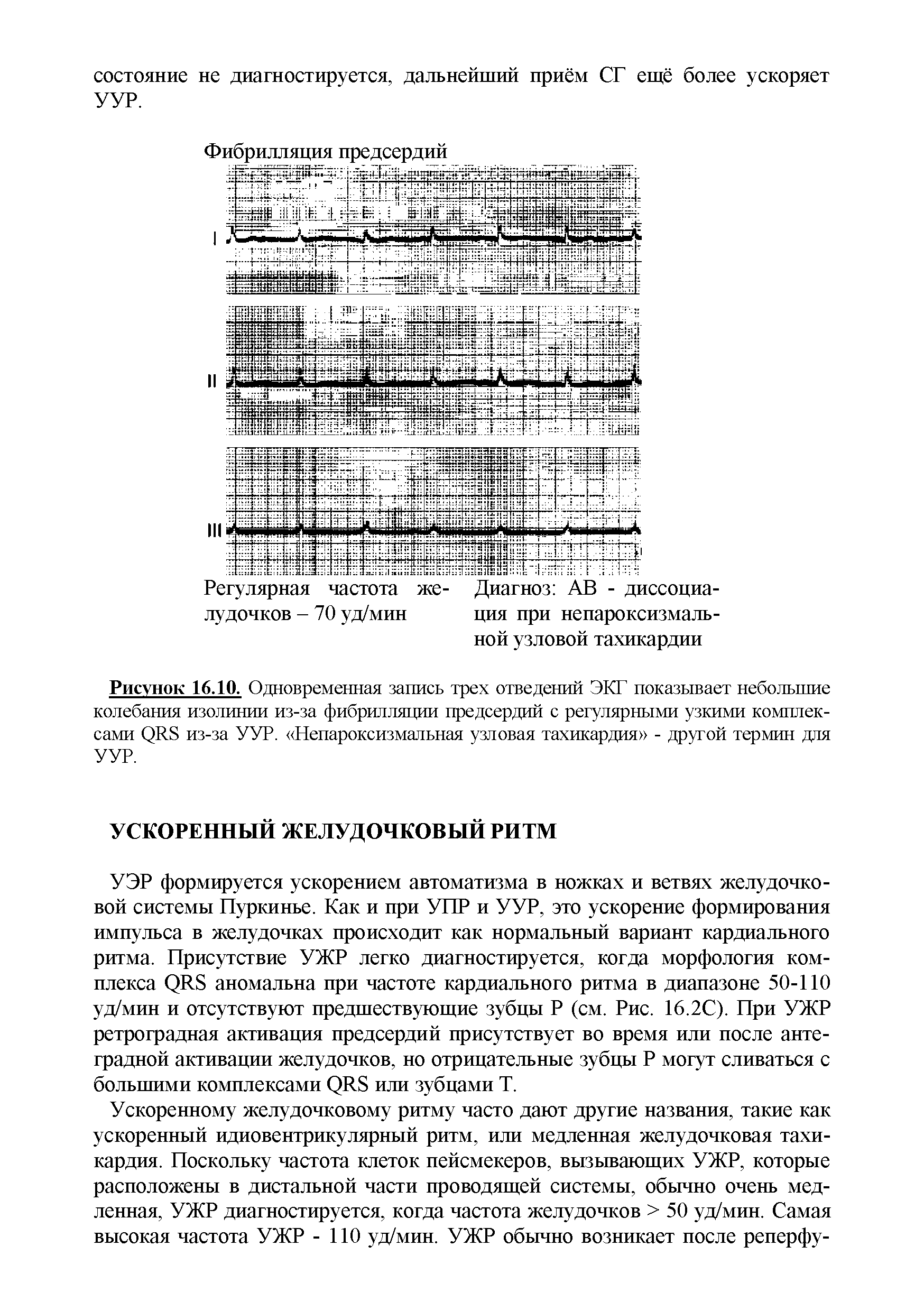 Рисунок 16.10. Одновременная запись трех отведений ЭКГ показывает небольшие колебания изолинии из-за фибрилляции предсердий с регулярными узкими комплексами (,)К5 из-за УУР. Непароксизмальная узловая тахикардия - другой термин для УУР.