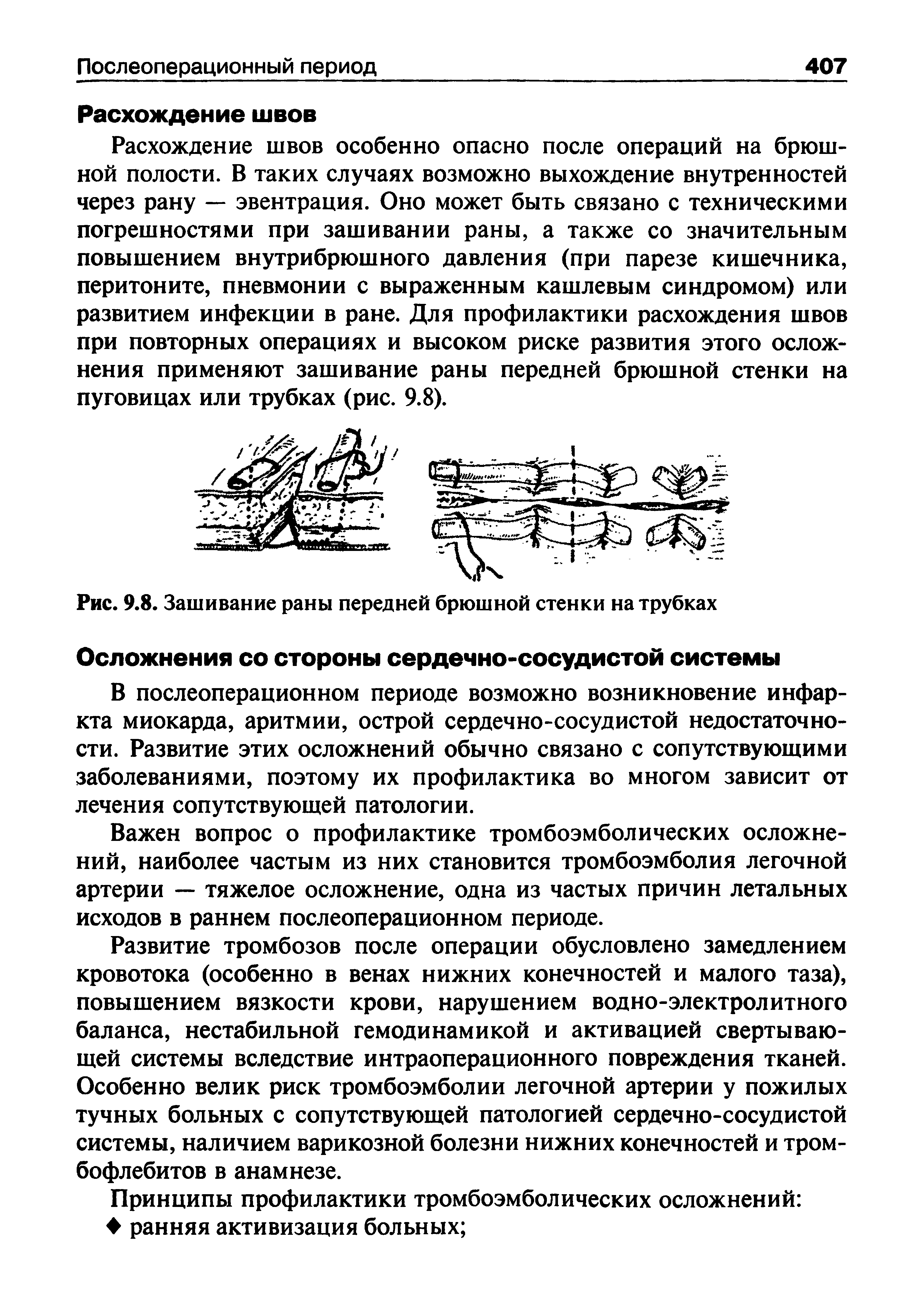 Рис. 9.8. Зашивание раны передней брюшной стенки на трубках...