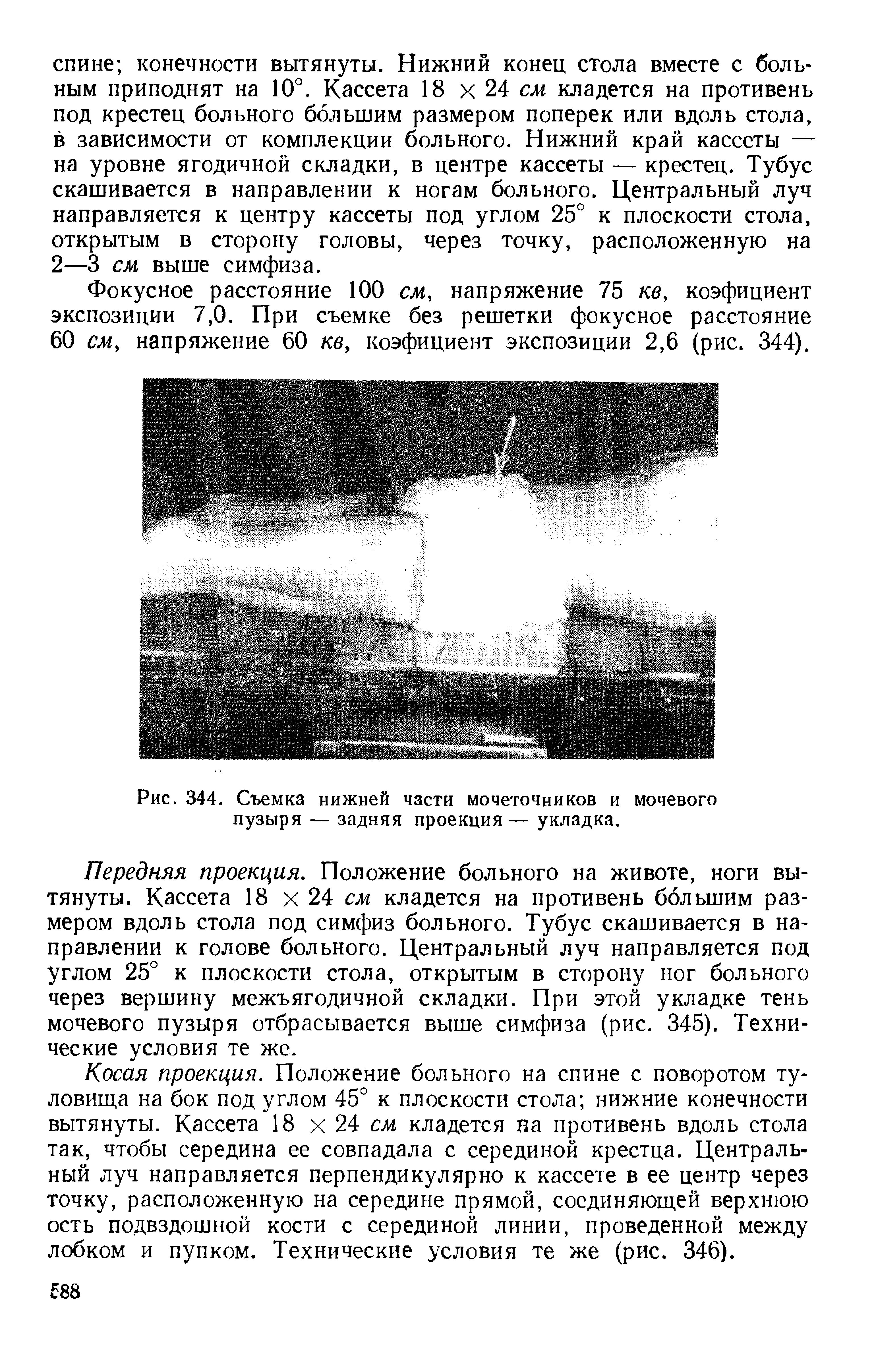 Рис. 344. Съемка нижней части мочеточников и мочевого пузыря — задняя проекция — укладка.