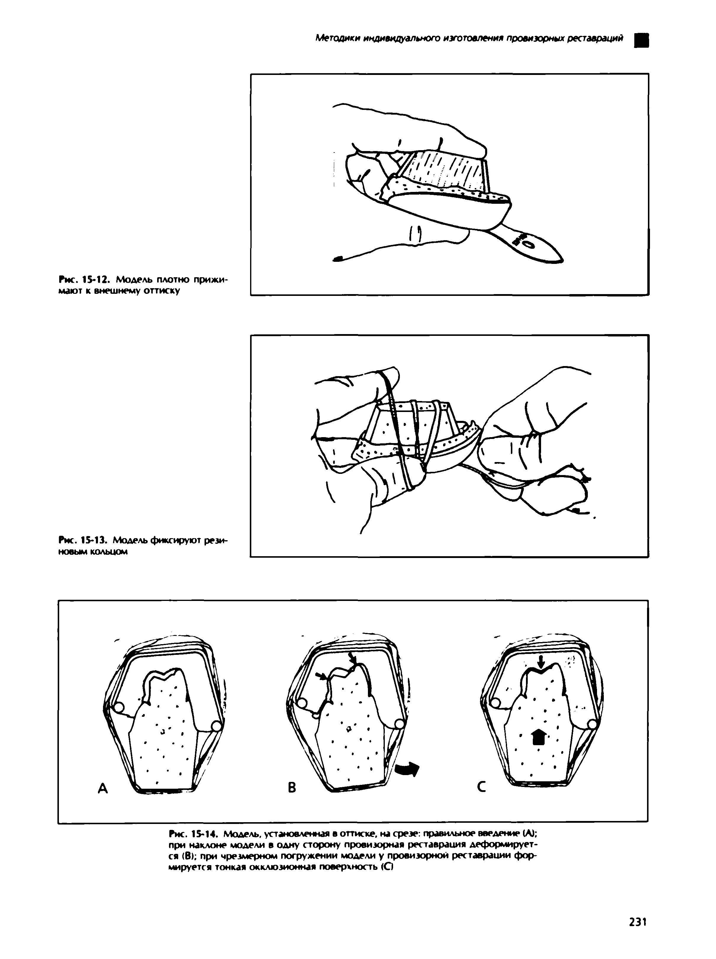 Рис. 15-14. Модель, установленная в оттиске, на срезе правильное введение (А) при наклоне модели в одну сторону провизорная реставрация деформируется (В) при чрезмерном погружении модели у провизорной реставрации формируется тонкая окклюзионная поверхность (О...