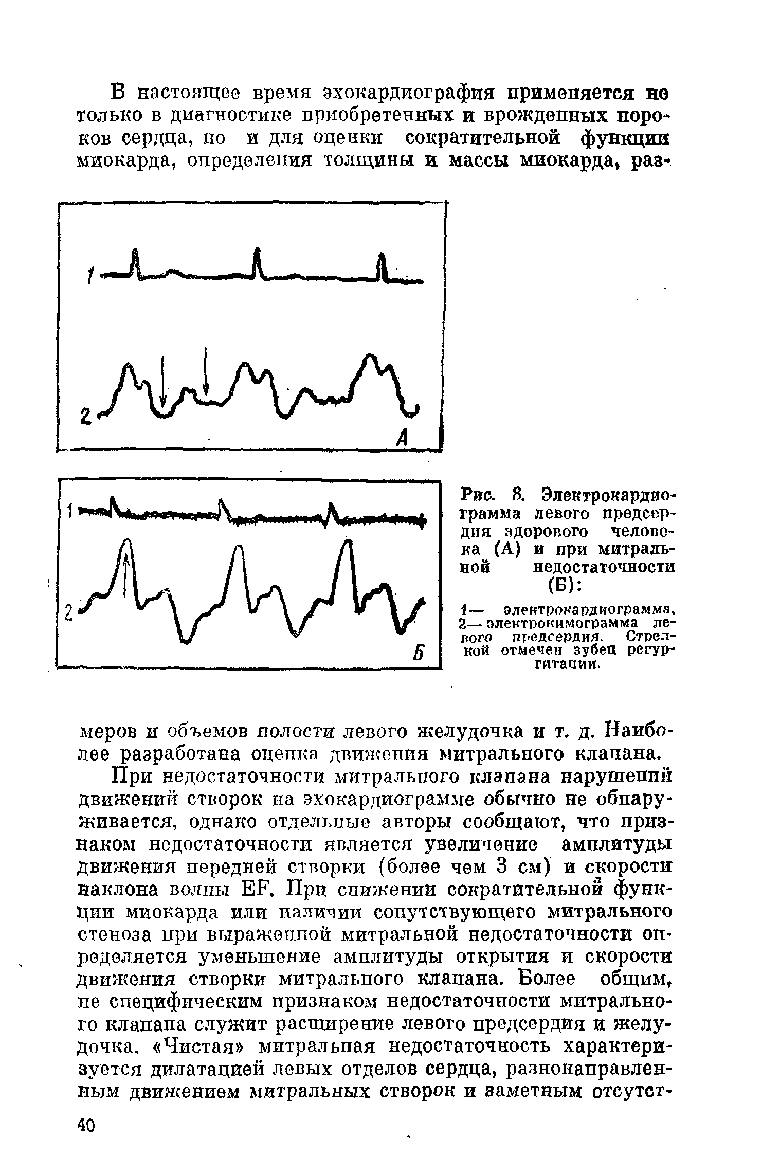 Рис. 8. Электрокардиограмма левого предсердия здорового человека (А) и при митральной недостаточности (Б) ...