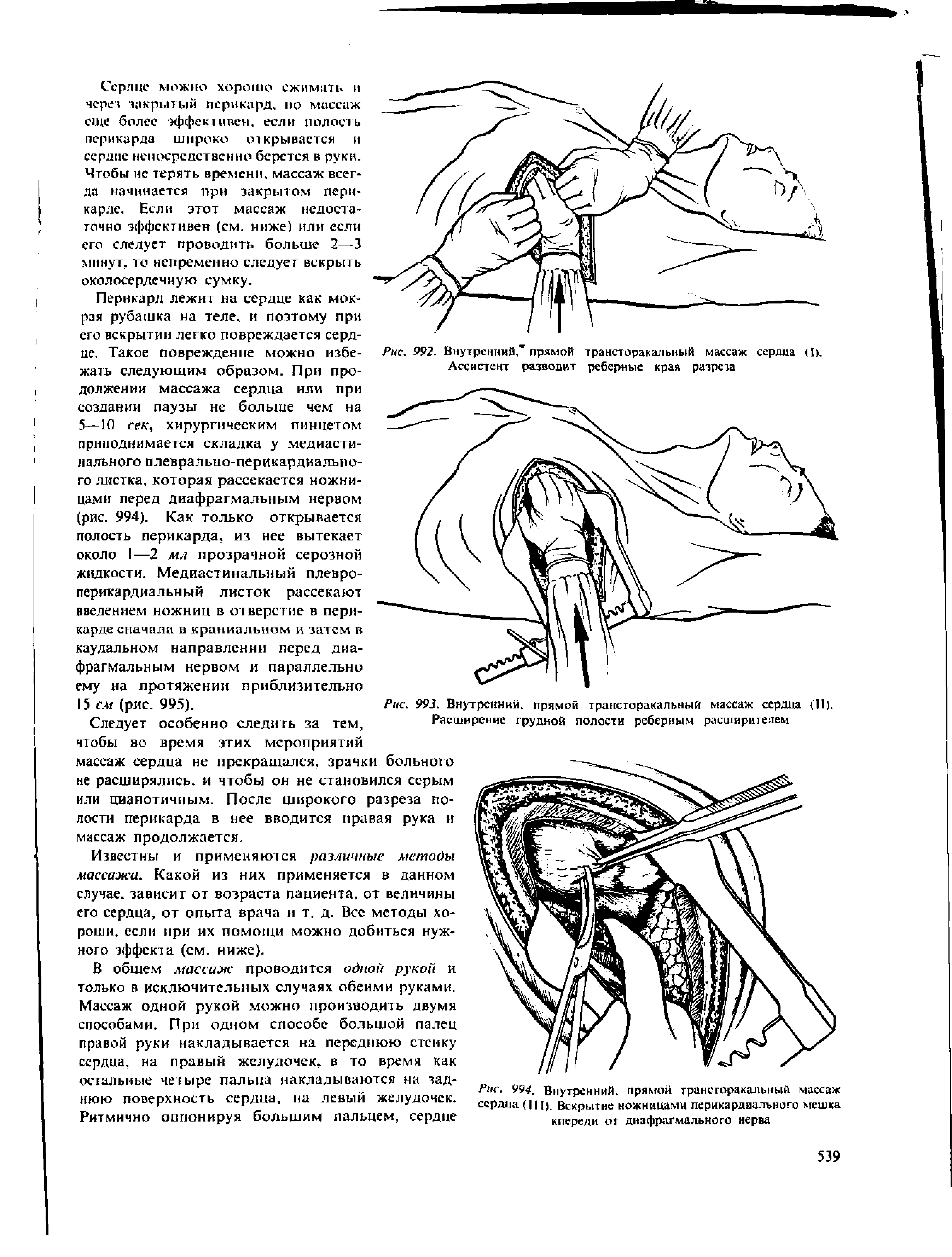 Рис. 993. Внутренний, прямой трансторакальный массаж сердца (11). Расширение грудной полости реберным расширителем...