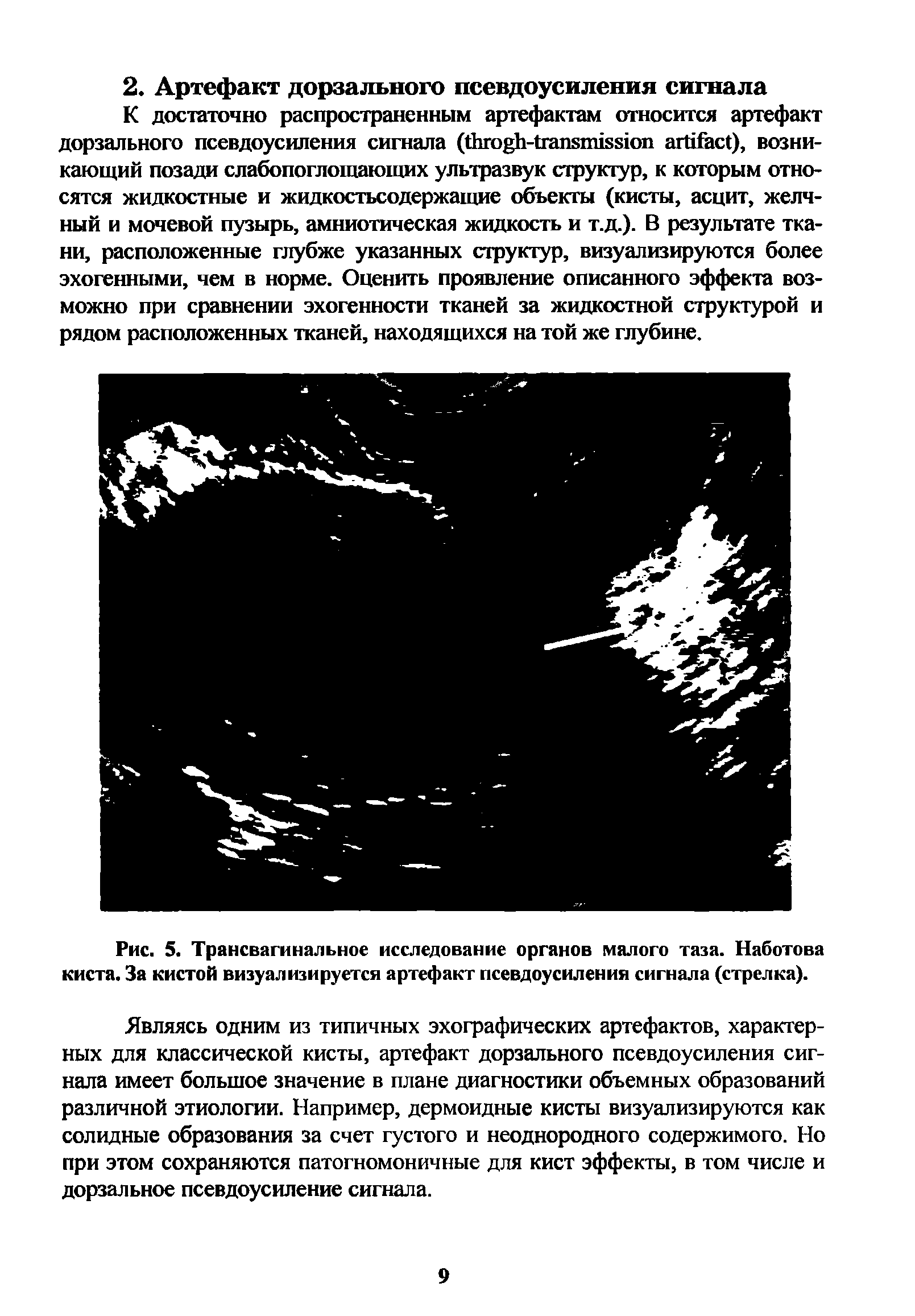 Рис. 5. Трансвагинальное исследование органов малого таза. Наботова киста. За кистой визуализируется артефакт псевдоусиления сигнала (стрелка).