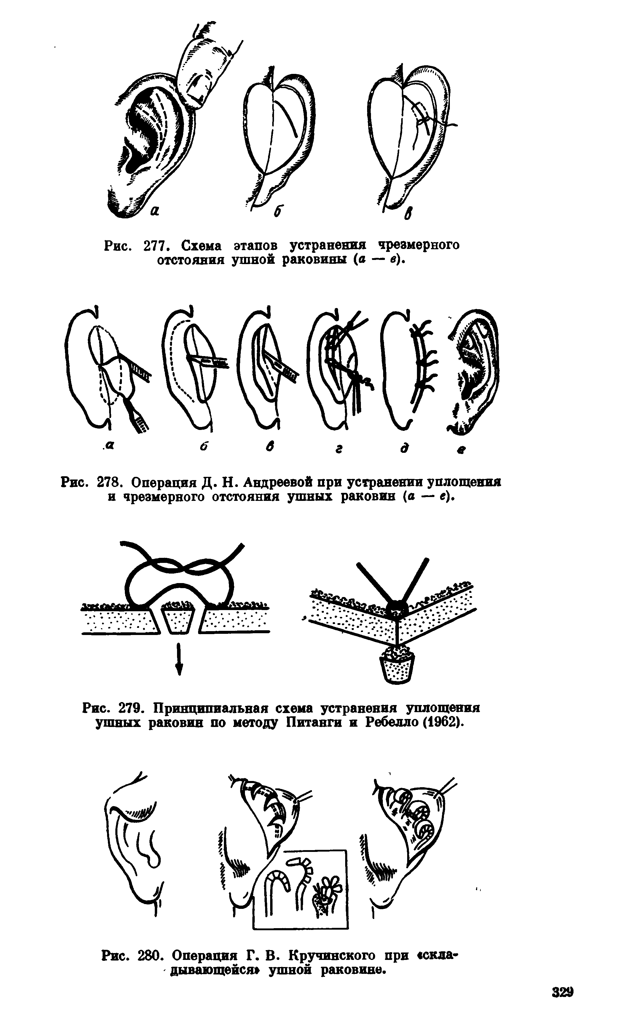 Рис. 278. Операция Д. Н. Андреевой при устранении уплощения и чрезмерного отстояния ушных раковин (а — е).
