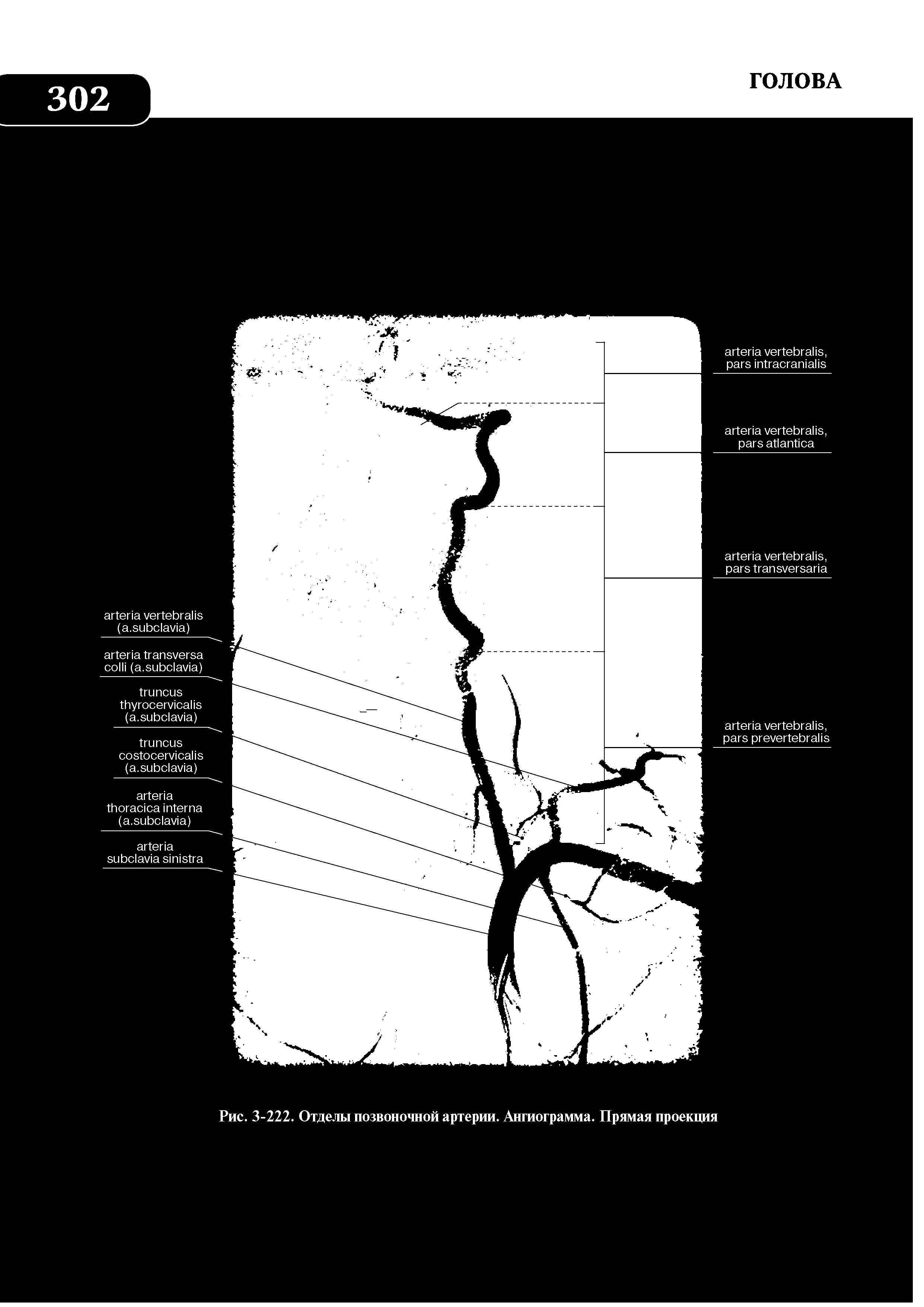 Рис. 3-222. Отделы позвоночной артерии. Ангиограмма. Прямая проекция...