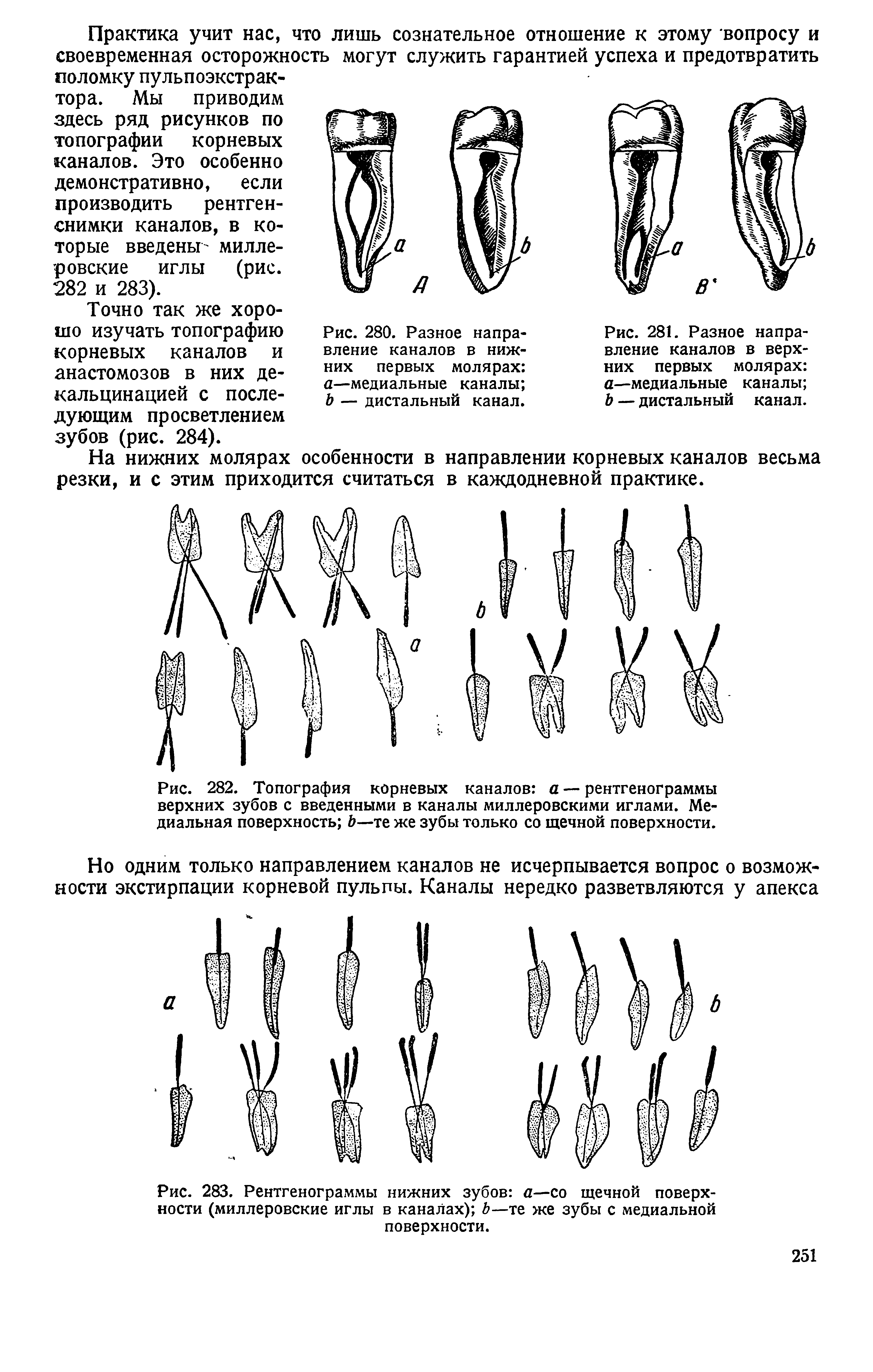 Рис. 281. Разное направление каналов в верхних первых молярах а—медиальные каналы Ъ — дистальный канал.