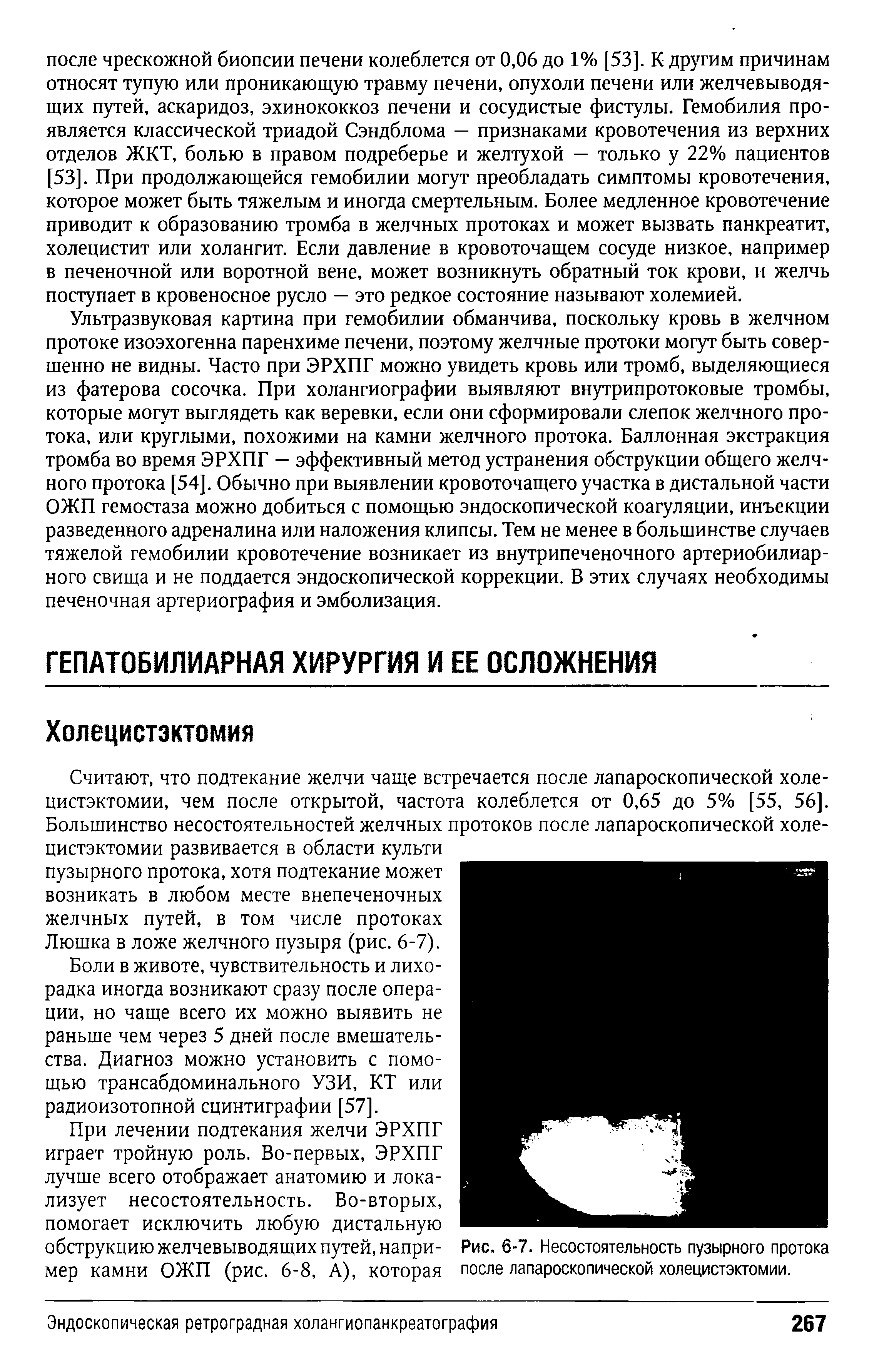 Рис. 6-7. Несостоятельность пузырного протока после лапароскопической холецистэктомии.