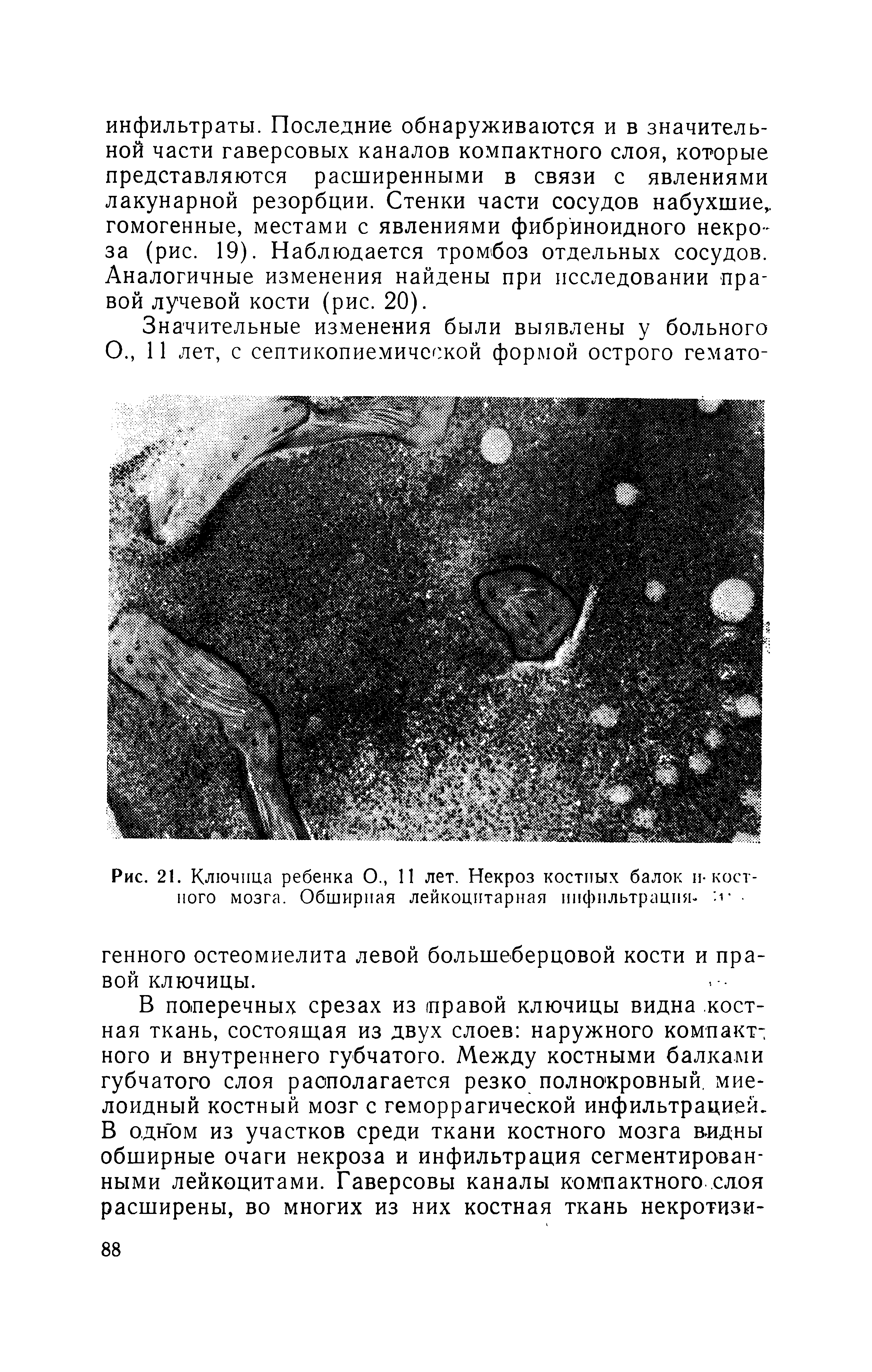 Рис. 21. Ключица ребенка О., И лет. Некроз костных балок и-костного мозга. Обширная лейкоцитарная инфильтрация-. ...