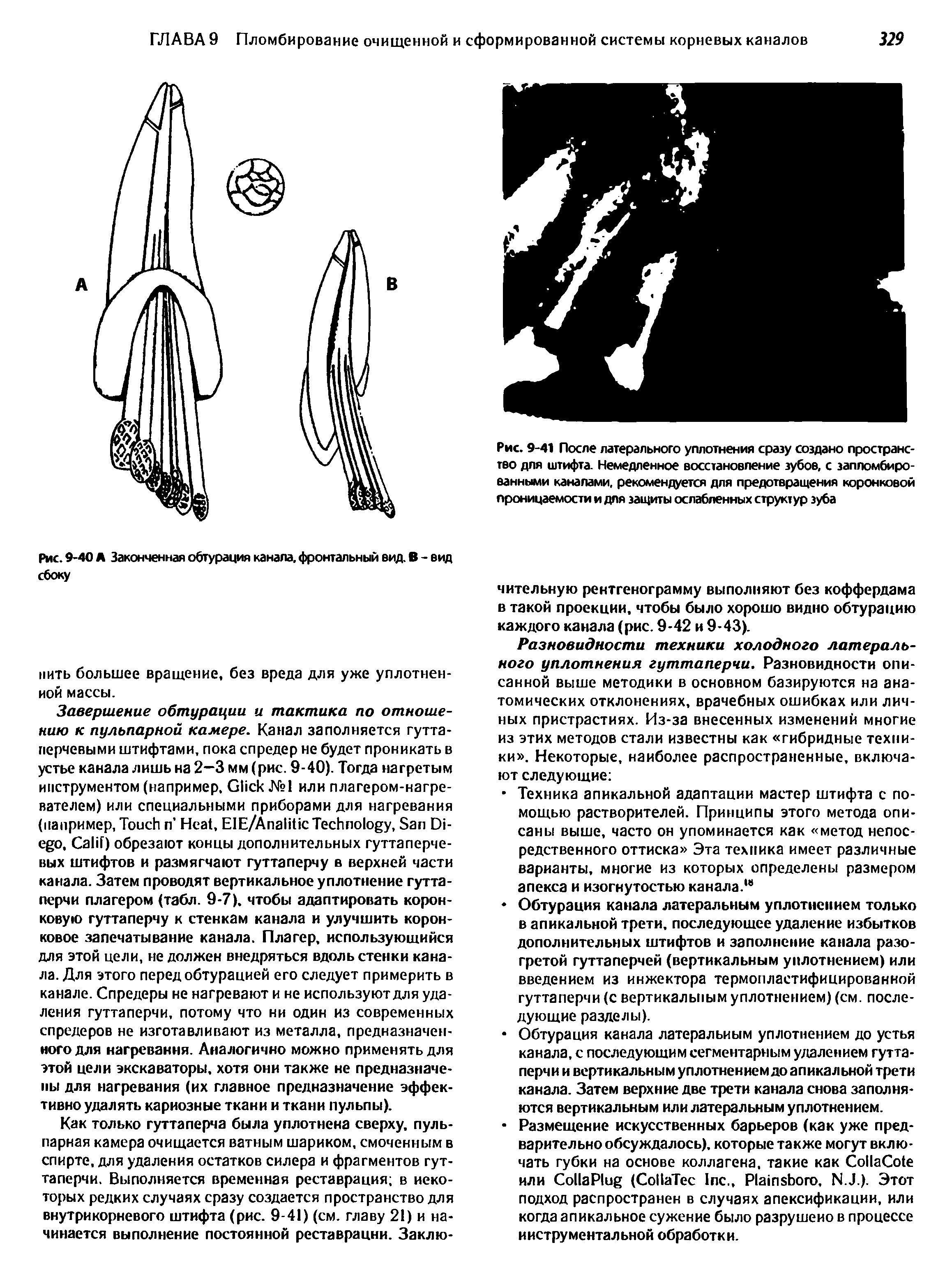 Рис. 9-41 После латерального уплотнения сразу создано пространство для штифта. Немедленное восстановление зубов, с запломбированными каналами, рекомендуется для предотвращения коронковой проницаемости и для защиты ослабленных структур зуба...