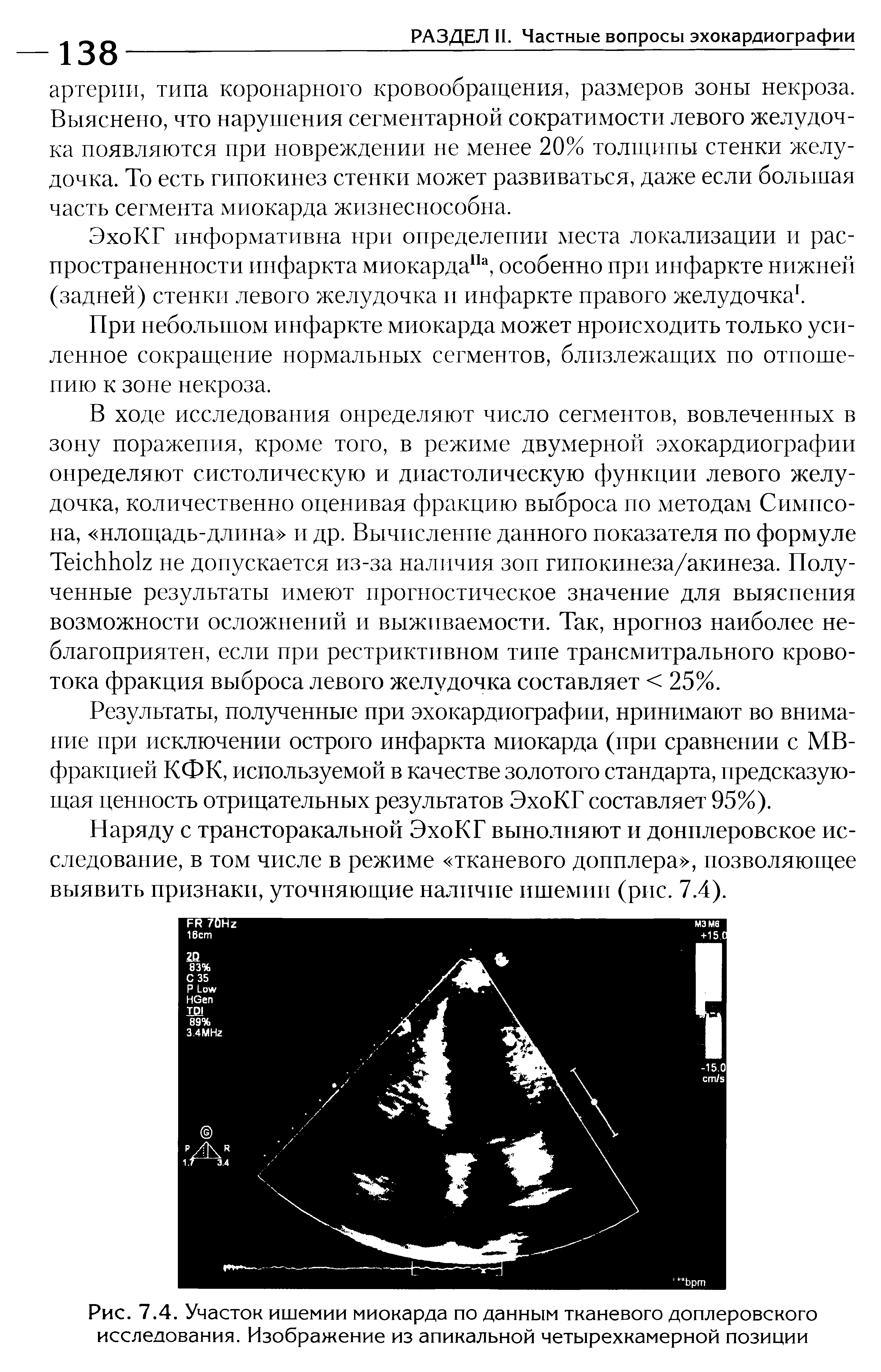 Рис. 7.4. Участок ишемии миокарда по данным тканевого доплеровского исследования. Изображение из апикальной четырехкамерной позиции...