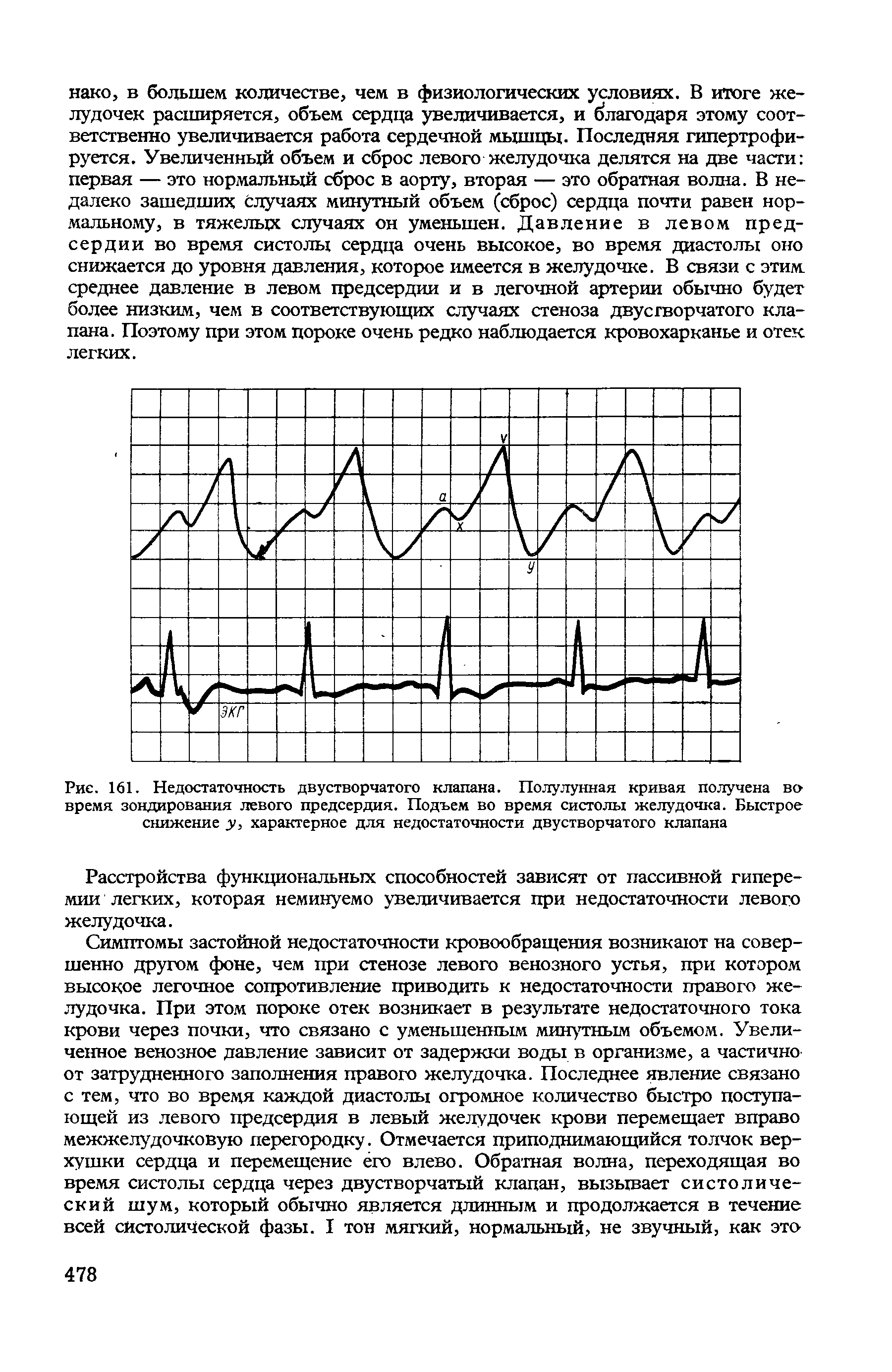 Рис. 161. Недостаточность двустворчатого клапана. Полулунная кривая получена во время зондирования левого предсердия. Подъем во время систолы желудочка. Быстрое снижение у, характерное для недостаточности двустворчатого клапана...