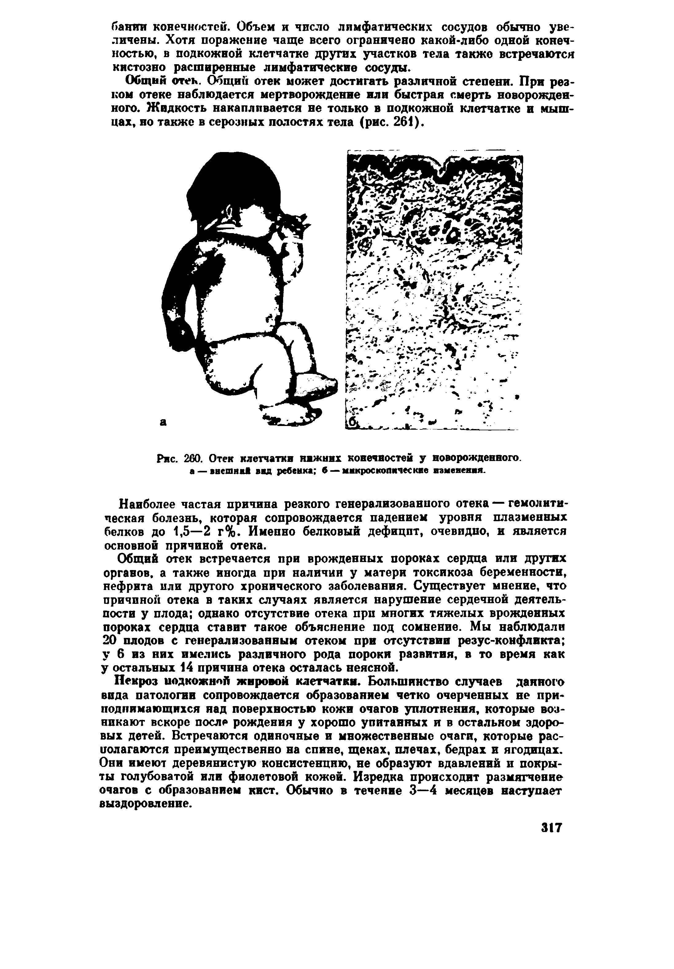 Рис. 260. Отек клетчатки нижних конечностей у новорожденного, а — внешка вад ребенка б — микроскопические изменения.