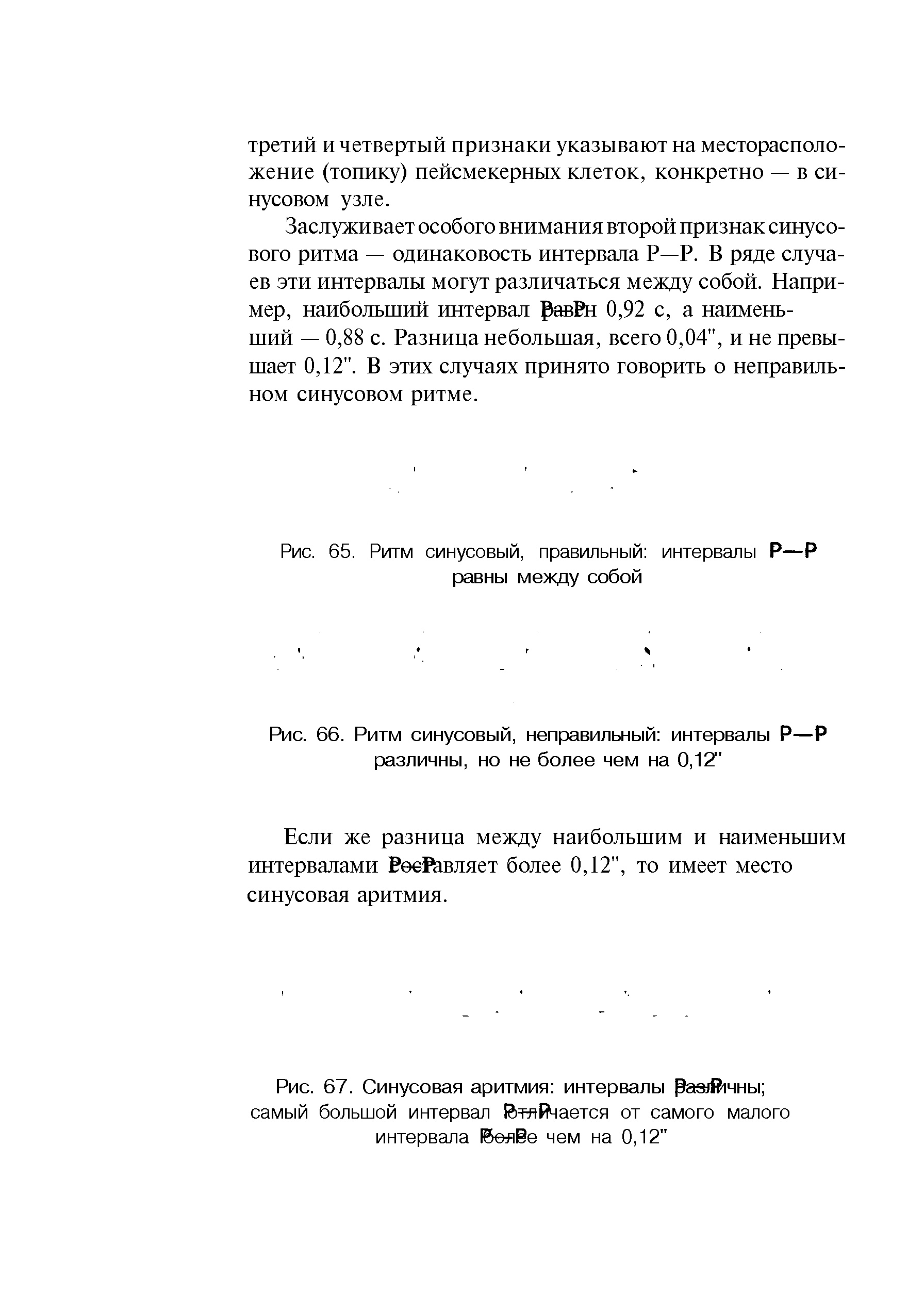 Рис. 66. Ритм синусовый, неправильный интервалы Р—Р различны, но не более чем на 0,12"...