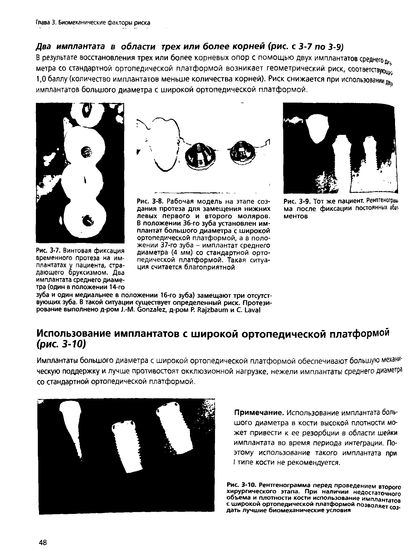 Рис. 3-10. Рентгенограмма перед проведением второго хирургического этапа. При наличии недостаточного объема и плотности кости использование имплантатов с широкой ортопедической платформой позволяет соз дать лучшие биомеханические условия...