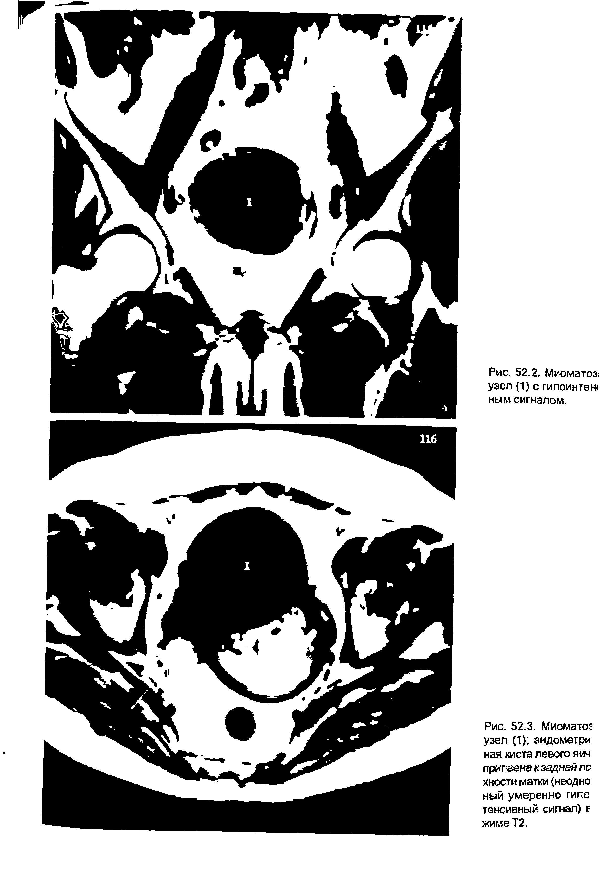 Рис. 52.3. Миомато узел (1) эндометри ная киста левого яич припаена к задней по хности матки (неодно ный умеренно гипе тенсиеный сигнал) е жиме Т2.