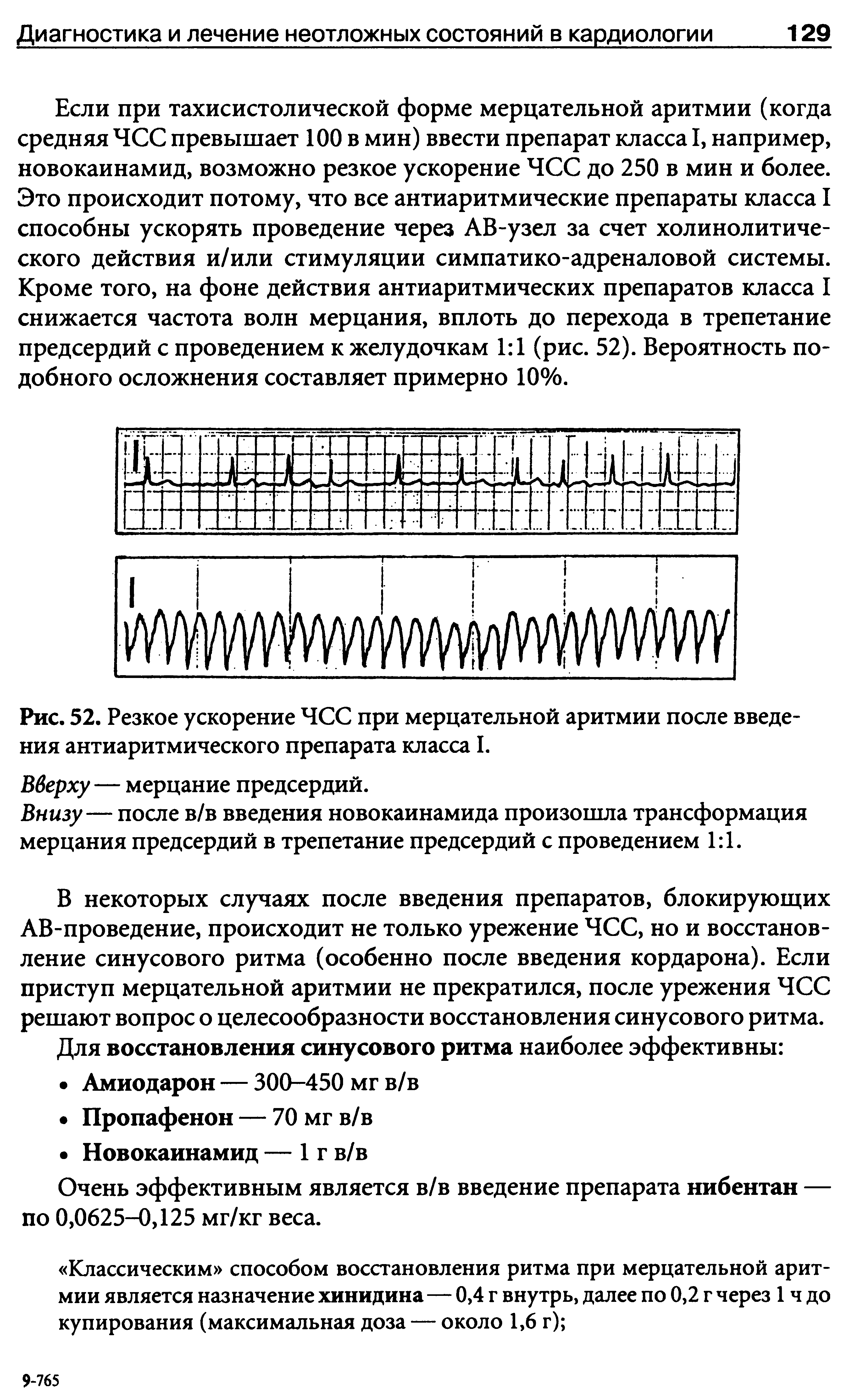 Рис. 52. Резкое ускорение ЧСС при мерцательной аритмии после введения антиаритмического препарата класса I.