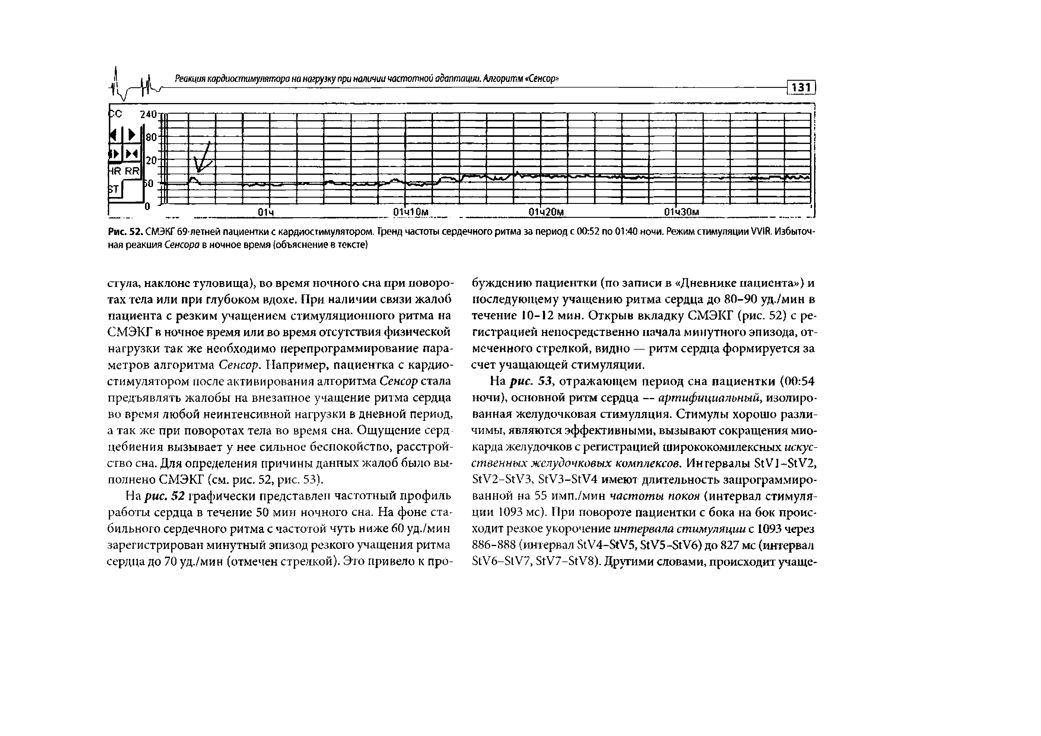 Рис. 52. СМЭКГ 69-летней пациентки с кардиостимулятором. Гренд частоты сердечного ритма за период с 00 52 по 01 40 ночи. Режим стимуляции WIR. Избыточная реакция Сенсора в ночное время (объяснение в тексте)...