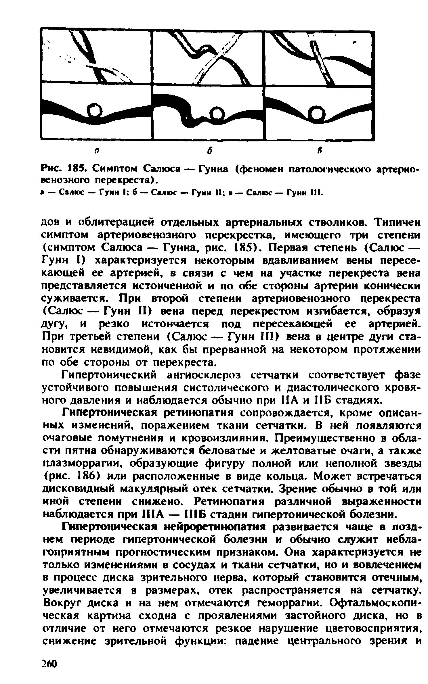 Рис. 185. Симптом Салиха — Гунна (феномен патологического артериовенозного перекреста).