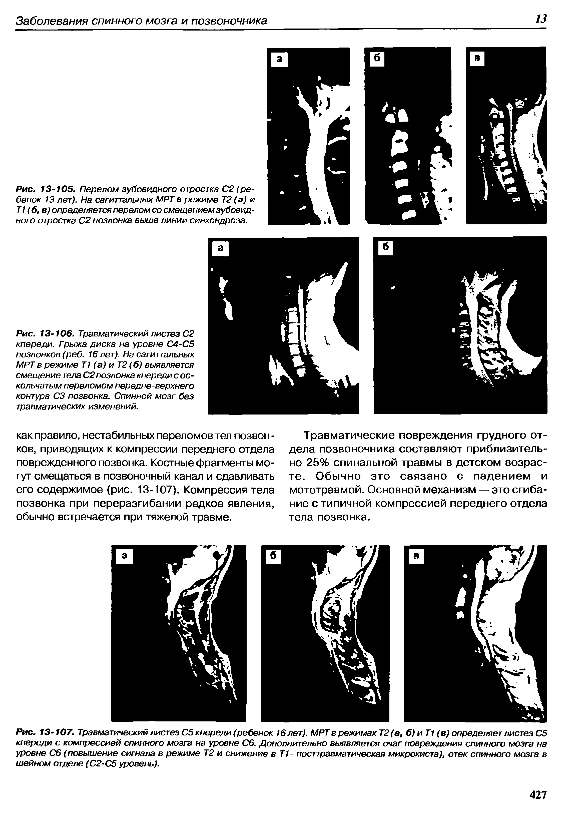 Рис. 13-106. Травматический листез С2 кпереди. Грыжа диска на уровне С4-С5 позвонков (реб. 16 лет). На сагиттальных МРТ в режиме Т1 (а) и Т2 (б) выявляется смещение тела С2 позвонка кпереди с оскольчатым переломом передне-верхнего контура СЗ позвонка. Спинной мозг без травматических изменений.