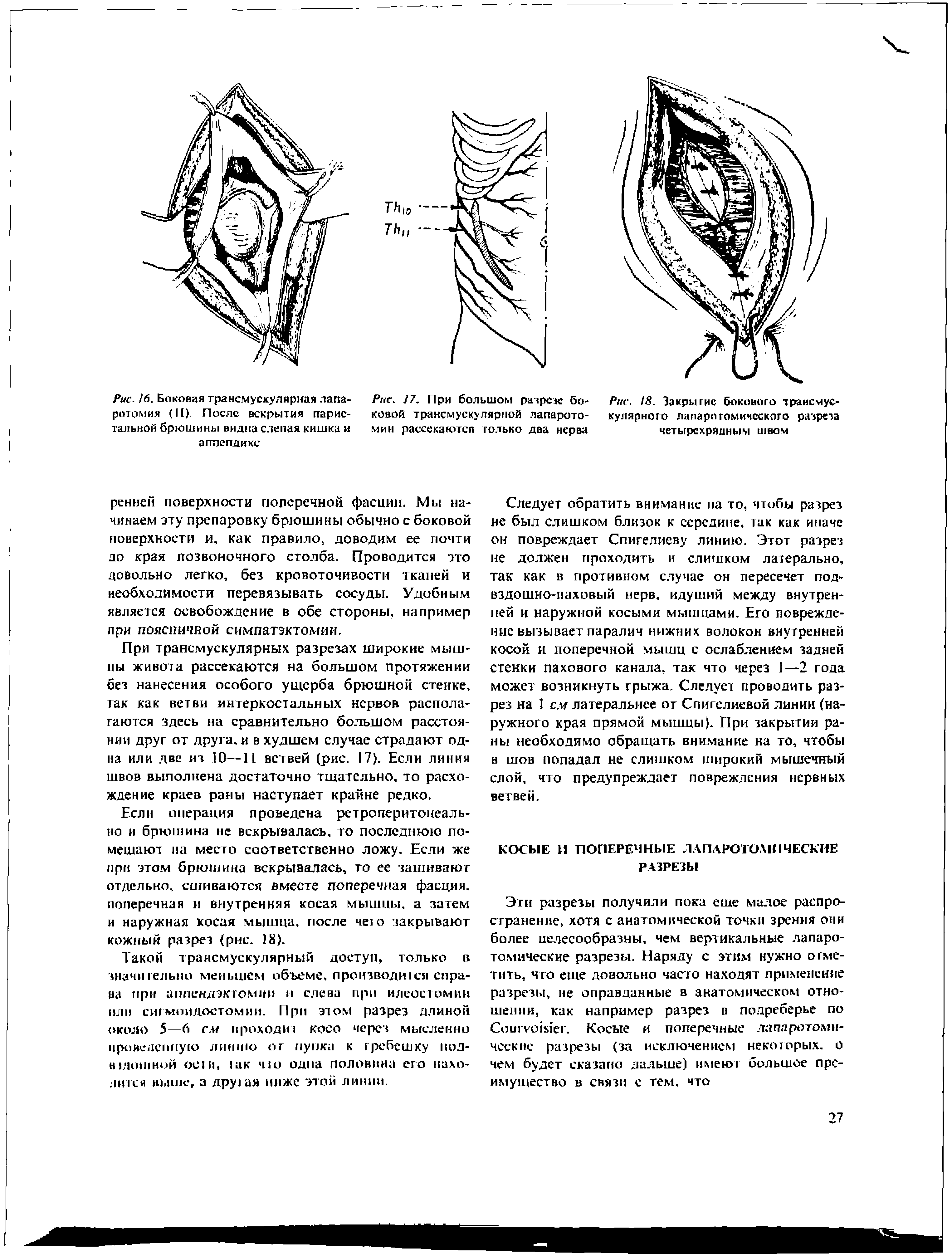 Рис. 7. При большом разрезе боковой трансмускулярной лапаротомии рассекаются только два нерва...