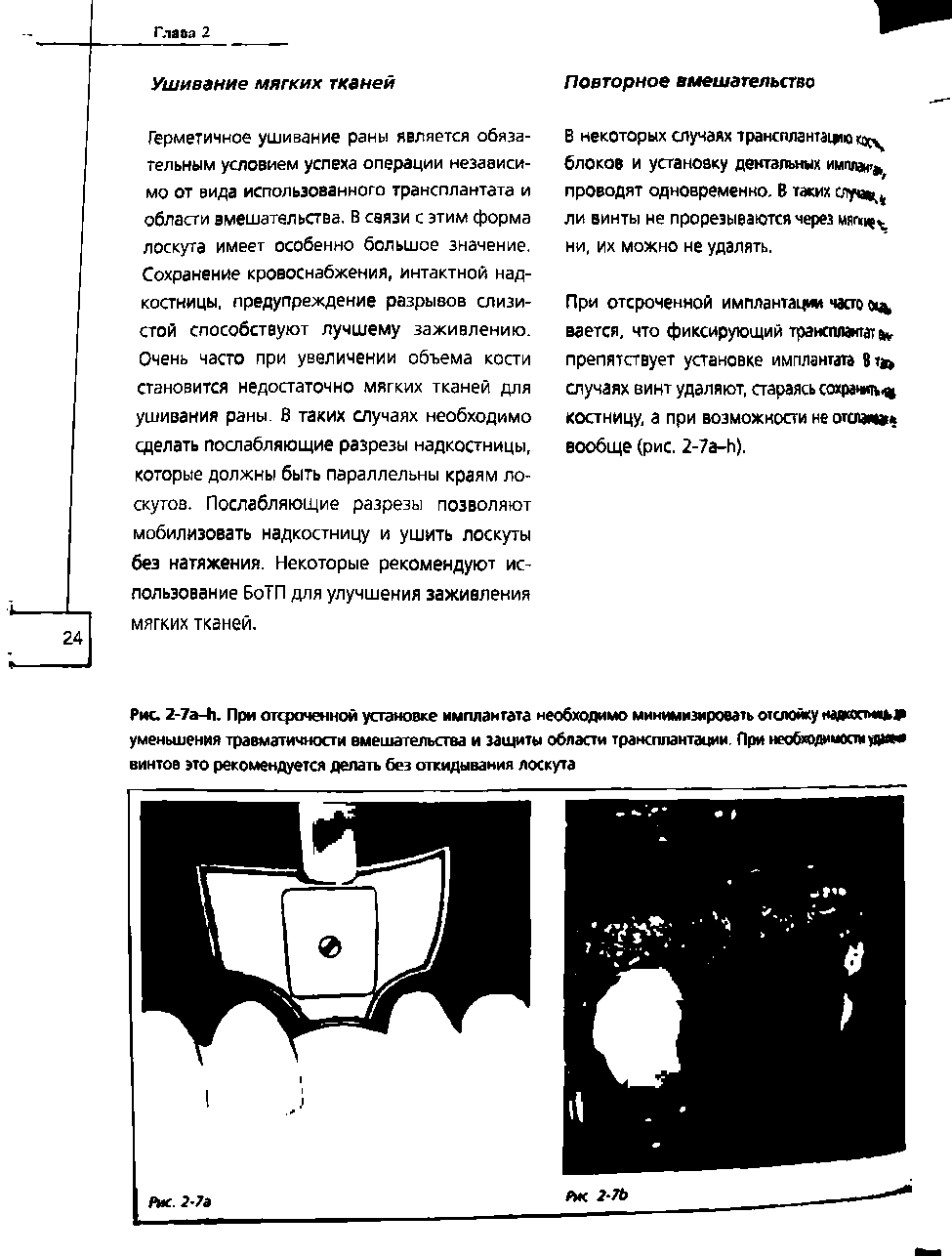 Рис. 2-7а-41. При отсроченной установке имплантата необходимо минимизировать отслойку наякостму уменьшения травматичности вмешательства и защиты области трансплантации. При необходимость да винтов это рекомендуется делать без откидывания лоскута...