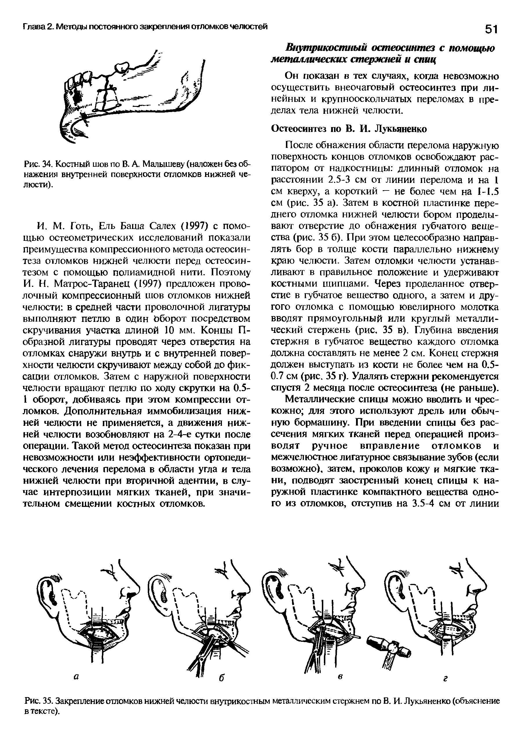 Рис. 34. Костный шов по В. А. Малышеву (наложен без обнажения внутренней поверхности отломков нижней челюсти).