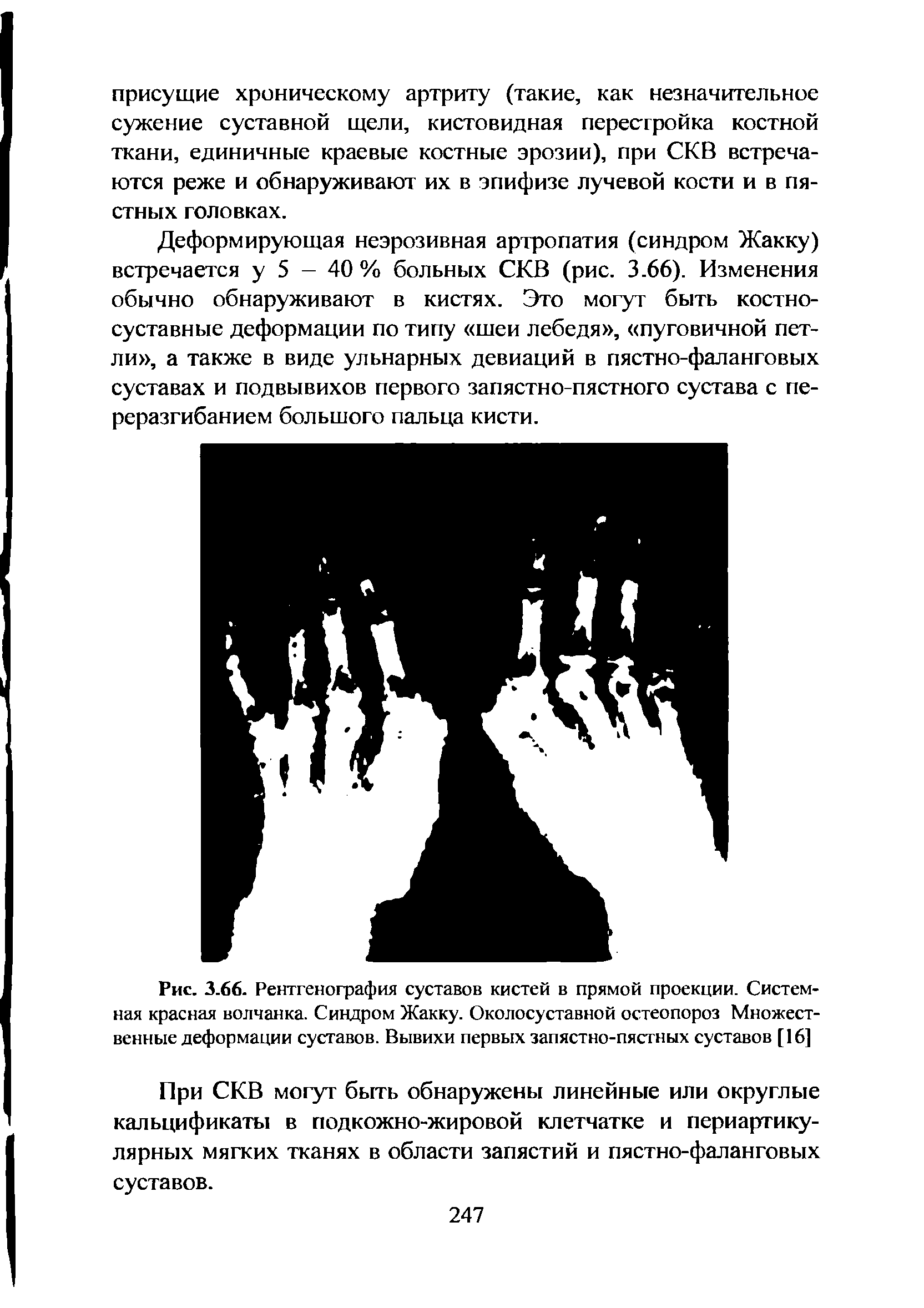 Рис. 3.66. Рентгенография суставов кистей в прямой проекции. Системная красная волчанка. Синдром Жакку. Околосуставной остеопороз Множественные деформации суставов. Вывихи первых запястно-пястных суставов [16]...