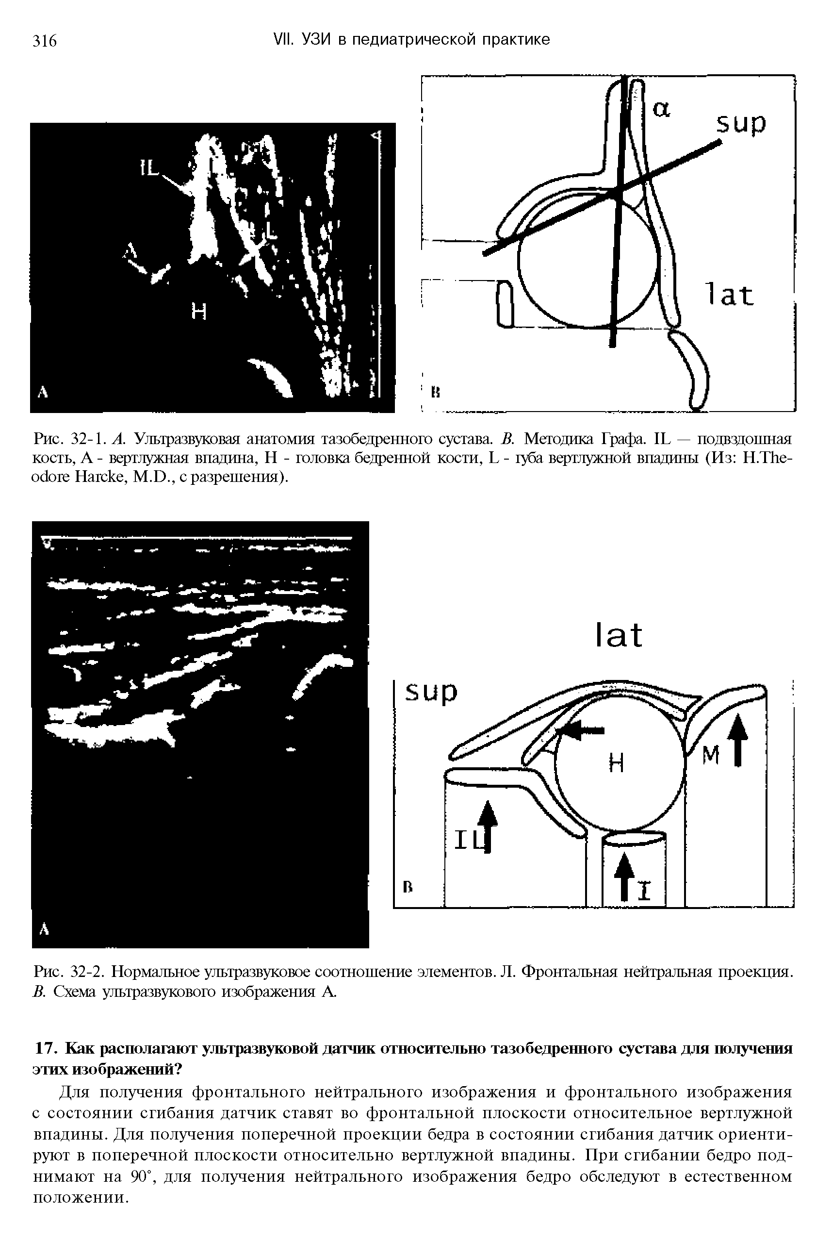 Рис. 32-1. А. Ультразвуковая анатомия тазобедренного сустава. В. Методика Графа. II. — подвздошная кость, А - вертлужная впадина, Н - головка бедренной кости, I. - губа вертлужной впадины (Из Н.Тйе-обоге Натеке, М.1).. с разрешения).
